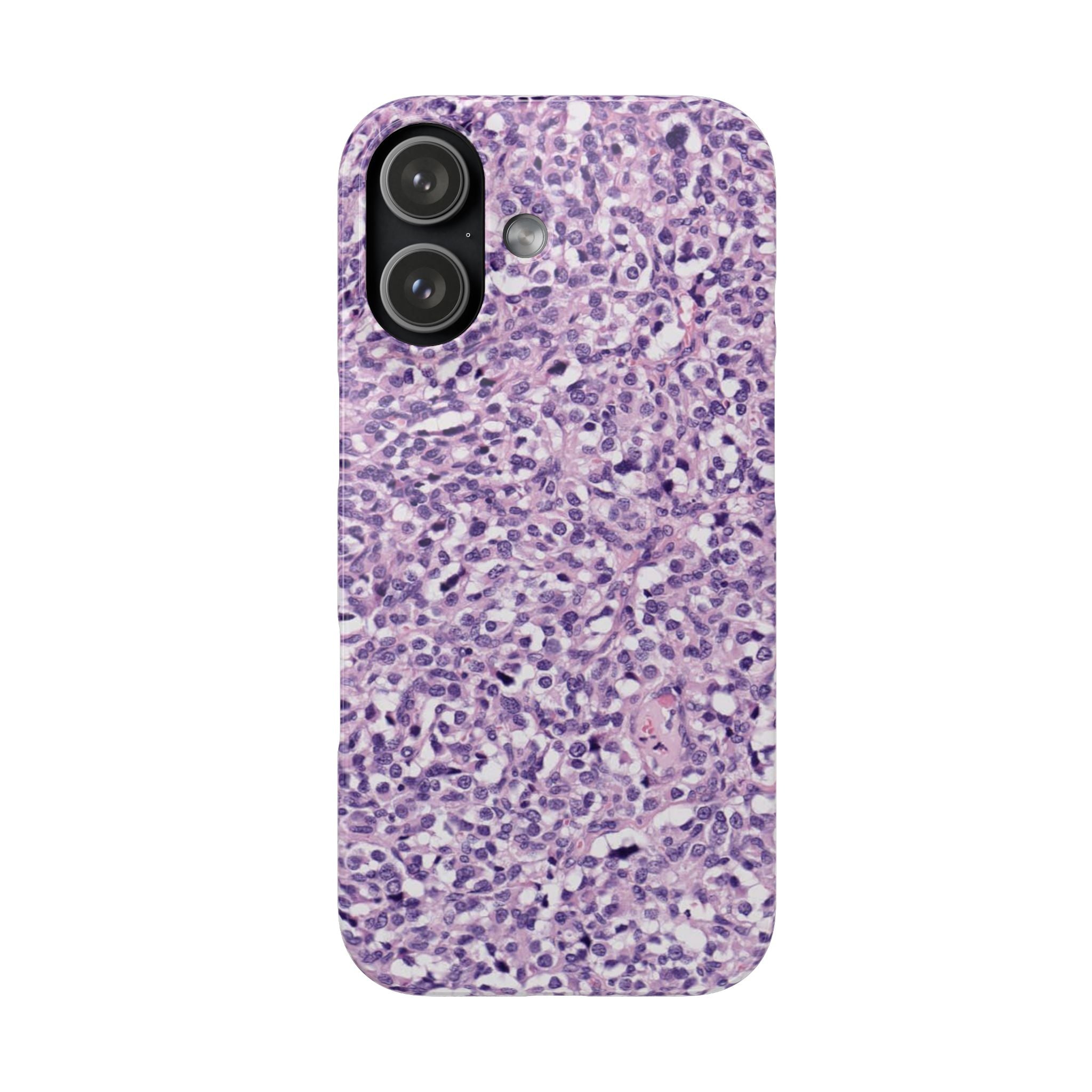 Slim Case Paraganglion