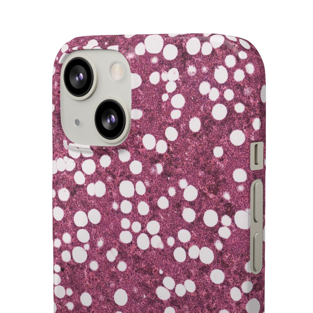 Slim Case Myelolipom