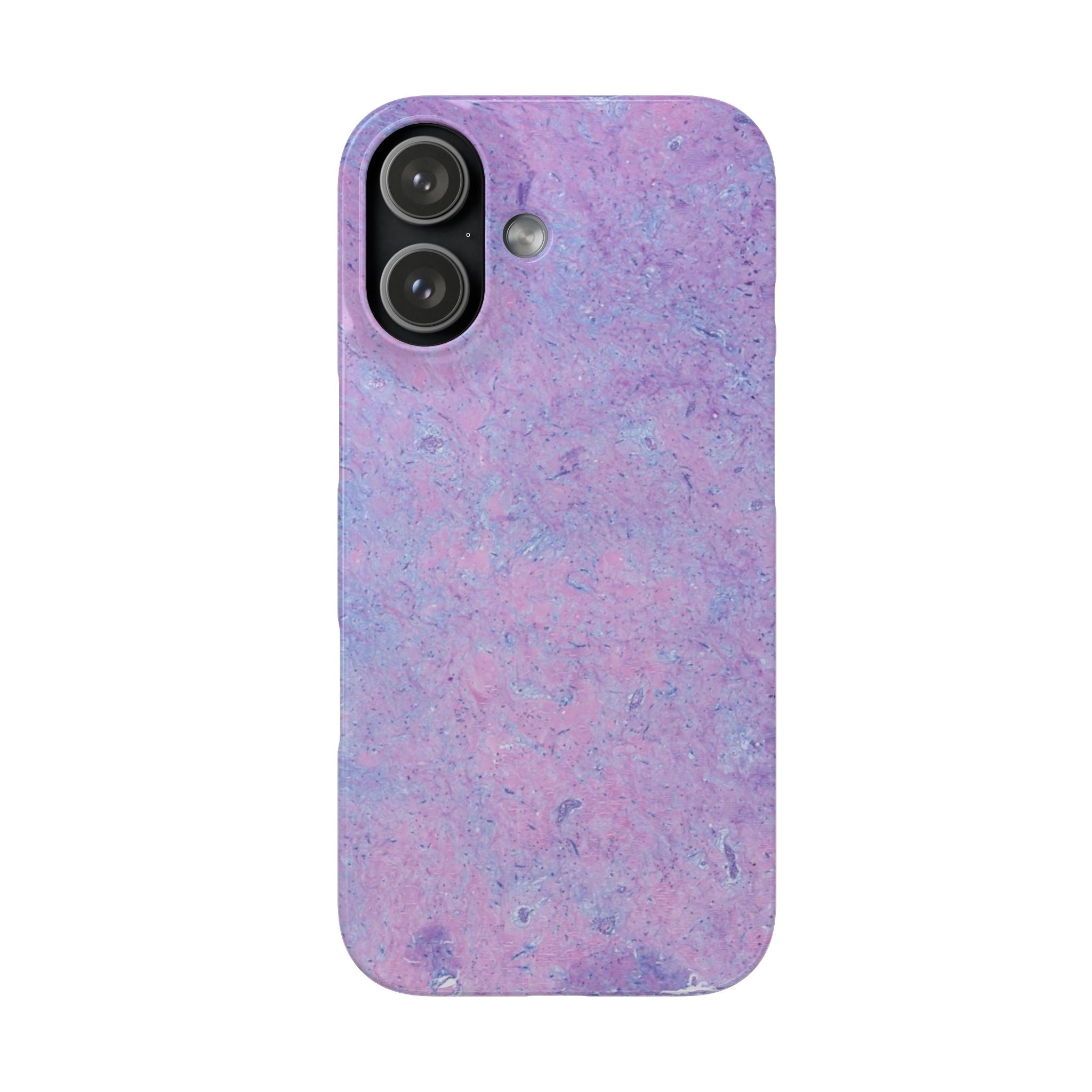Slim Case Arterielles Myxom