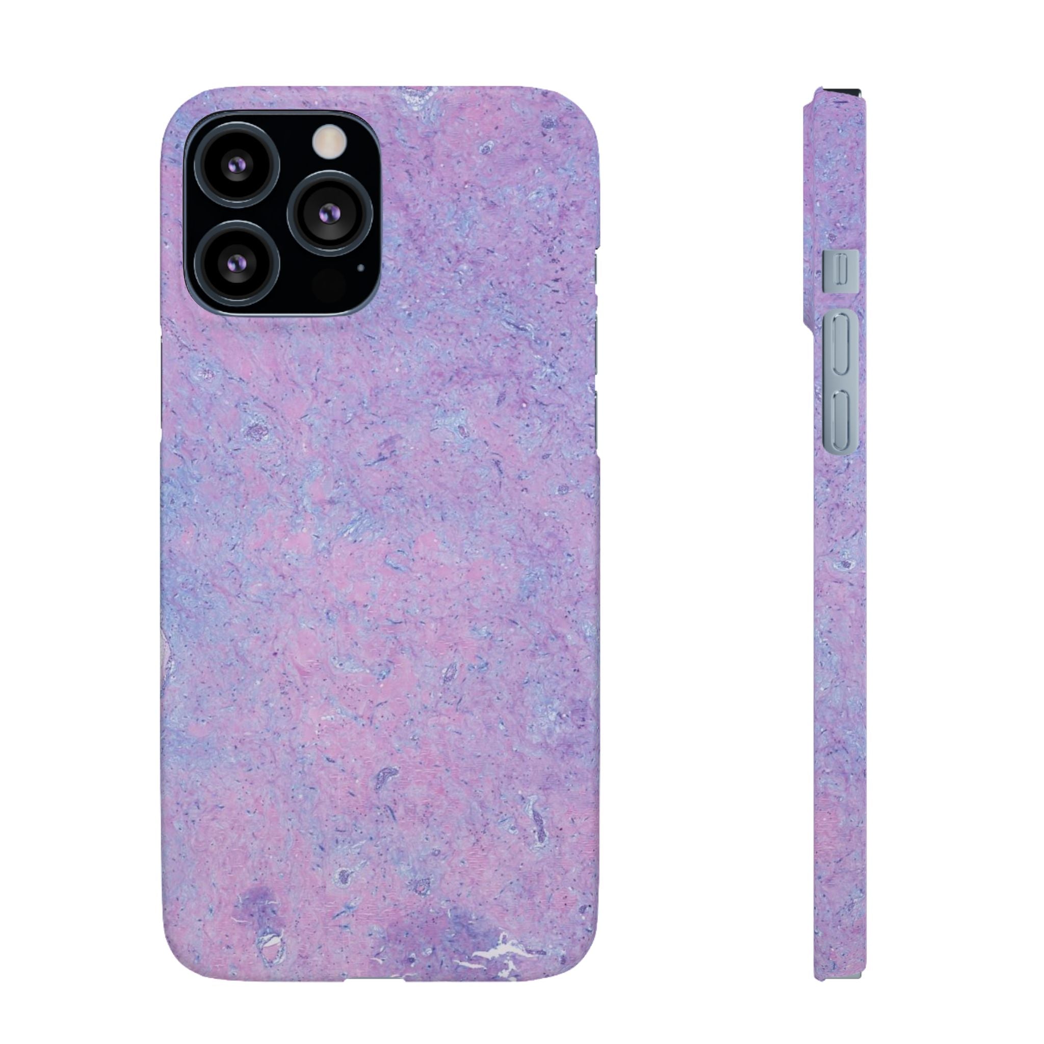 Slim Case Arterielles Myxom