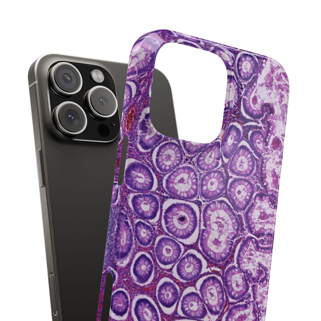 Slim Case Peutz-Jeghers Polyp