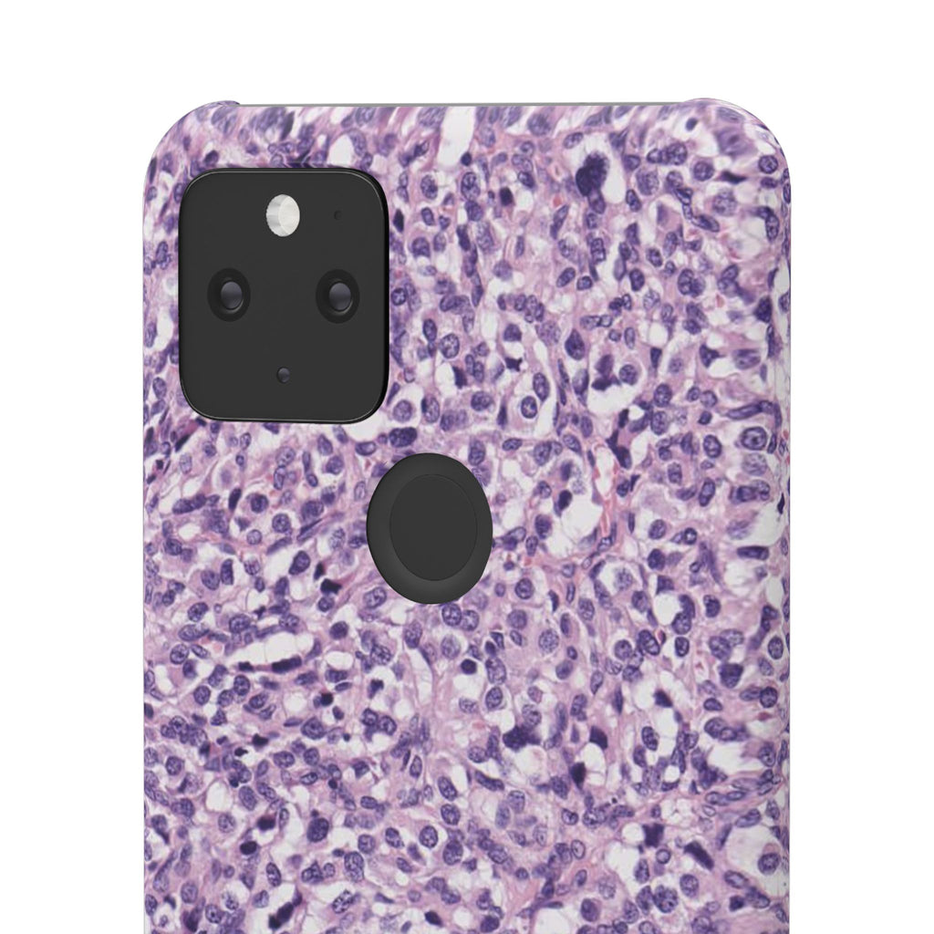 Slim Case Paraganglion