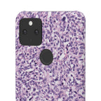 Slim Case Paraganglion