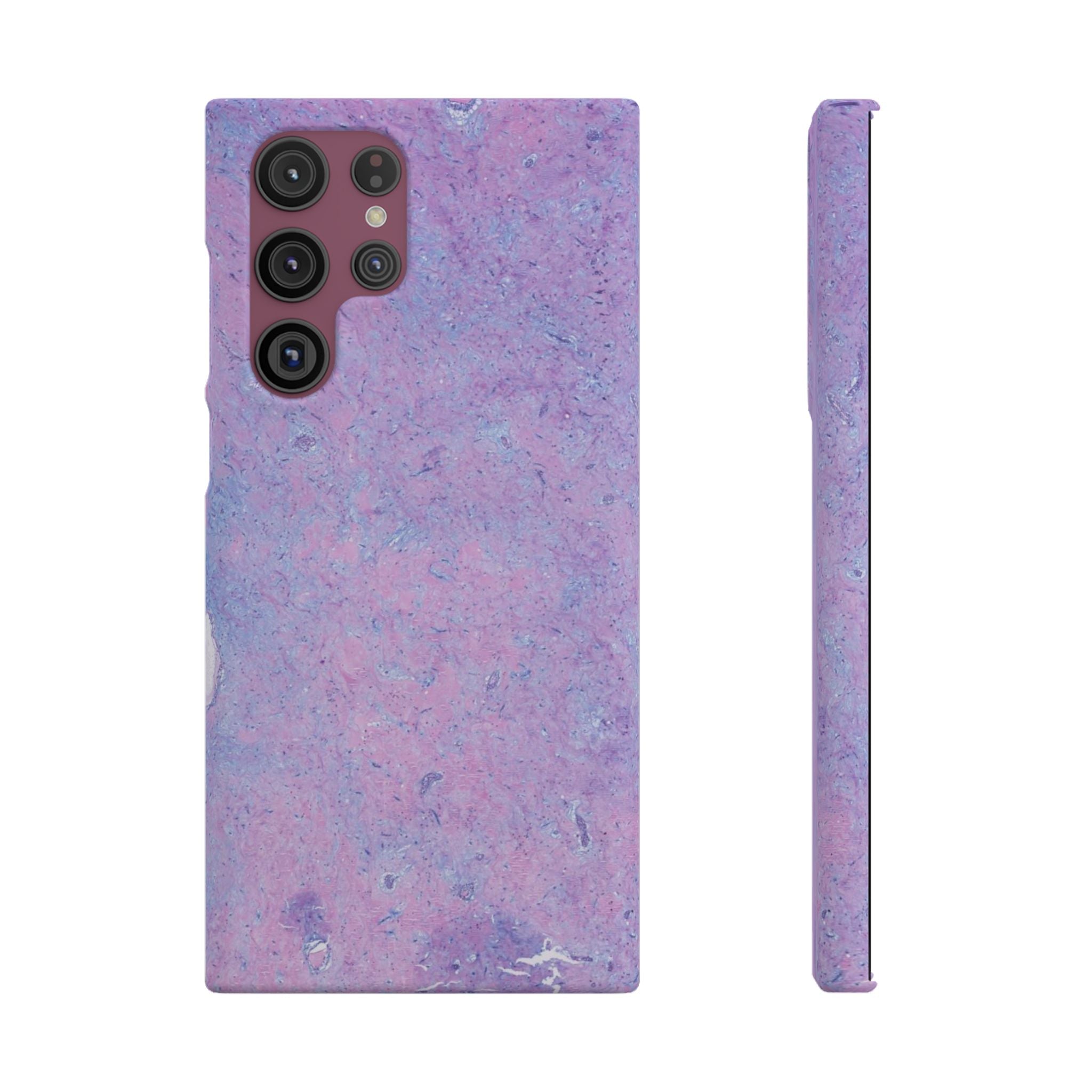 Slim Case Arterielles Myxom