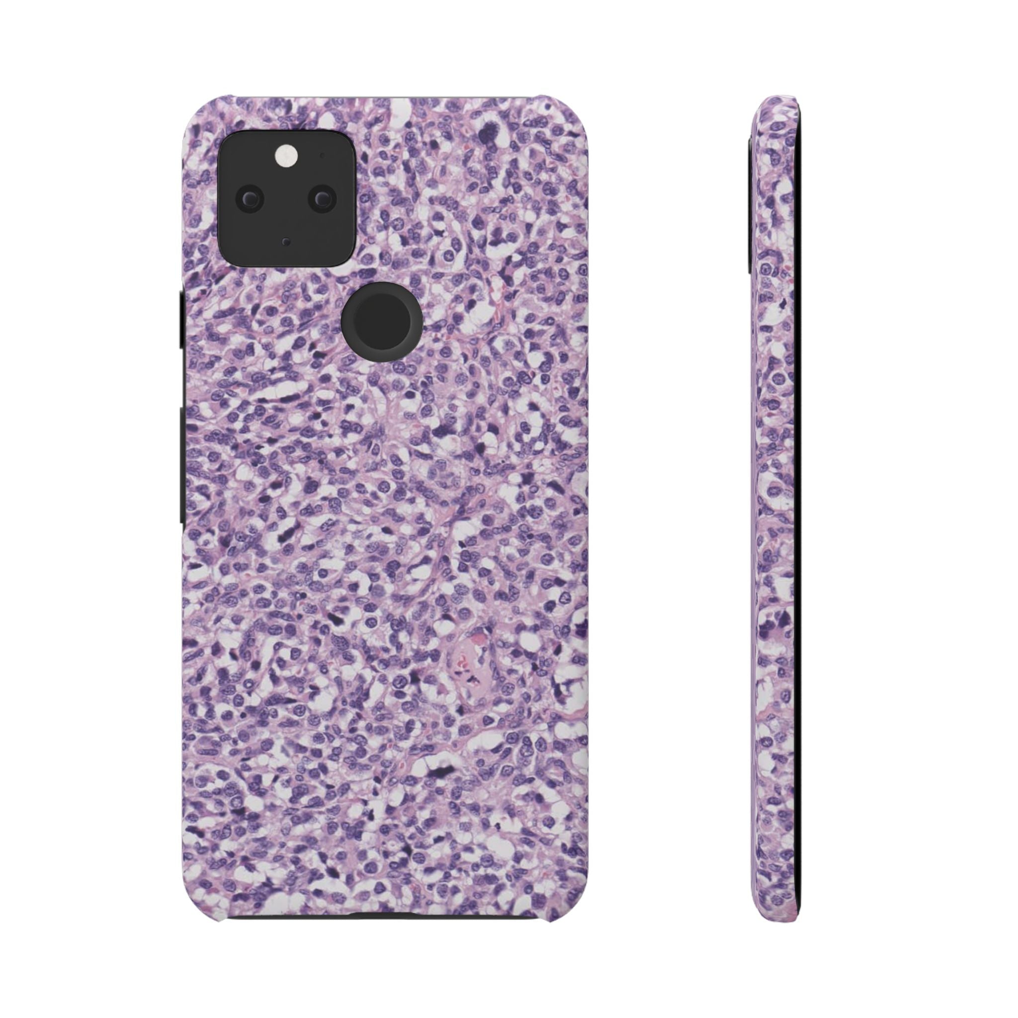Slim Case Paraganglion