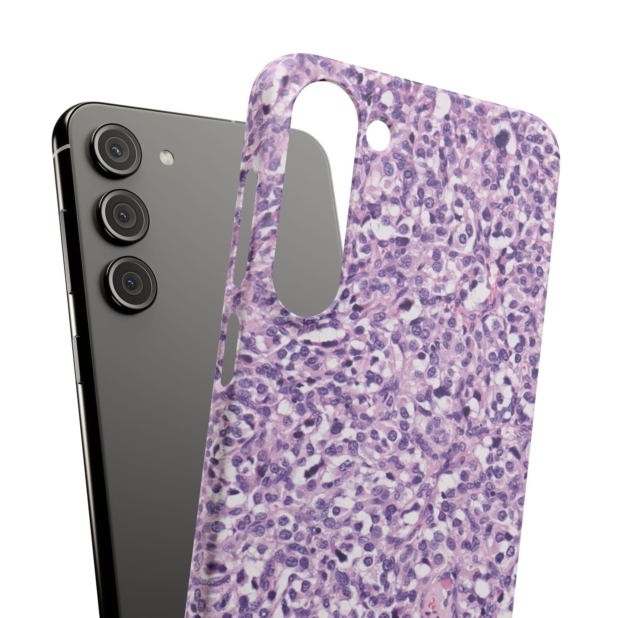Slim Case Paraganglion