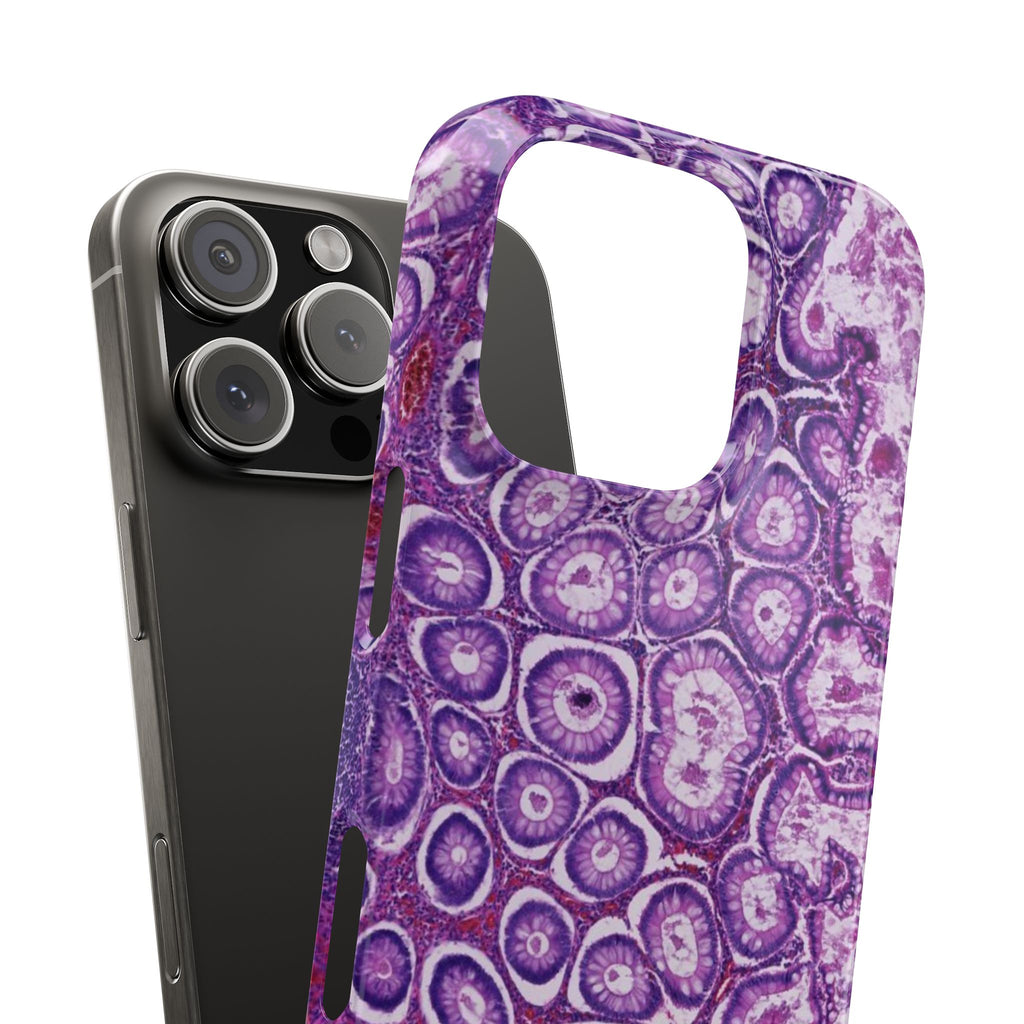 Slim Case Peutz-Jeghers Polyp