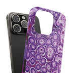 Slim Case Peutz-Jeghers Polyp