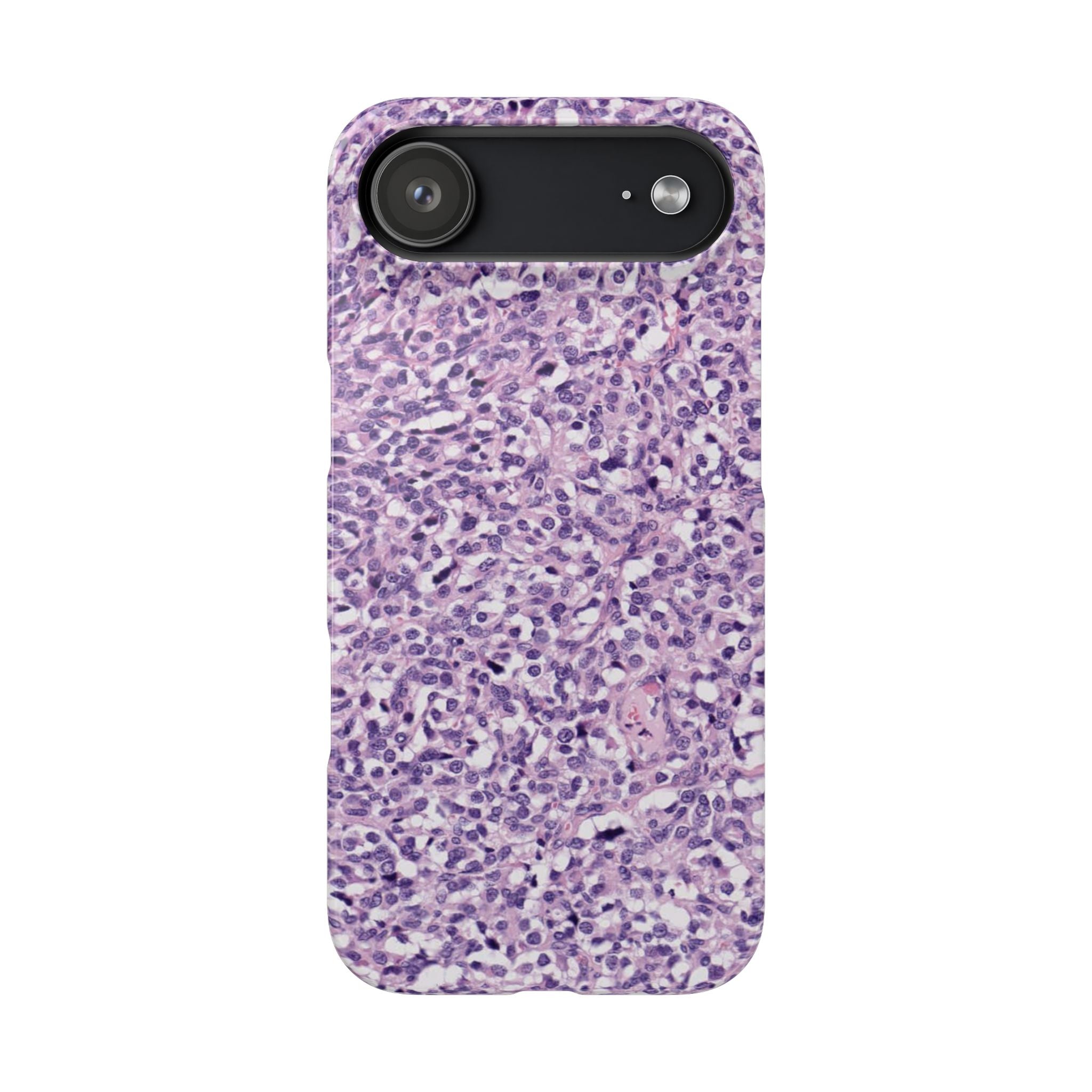 Slim Case Paraganglion