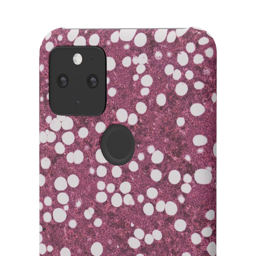 Slim Case Myelolipom