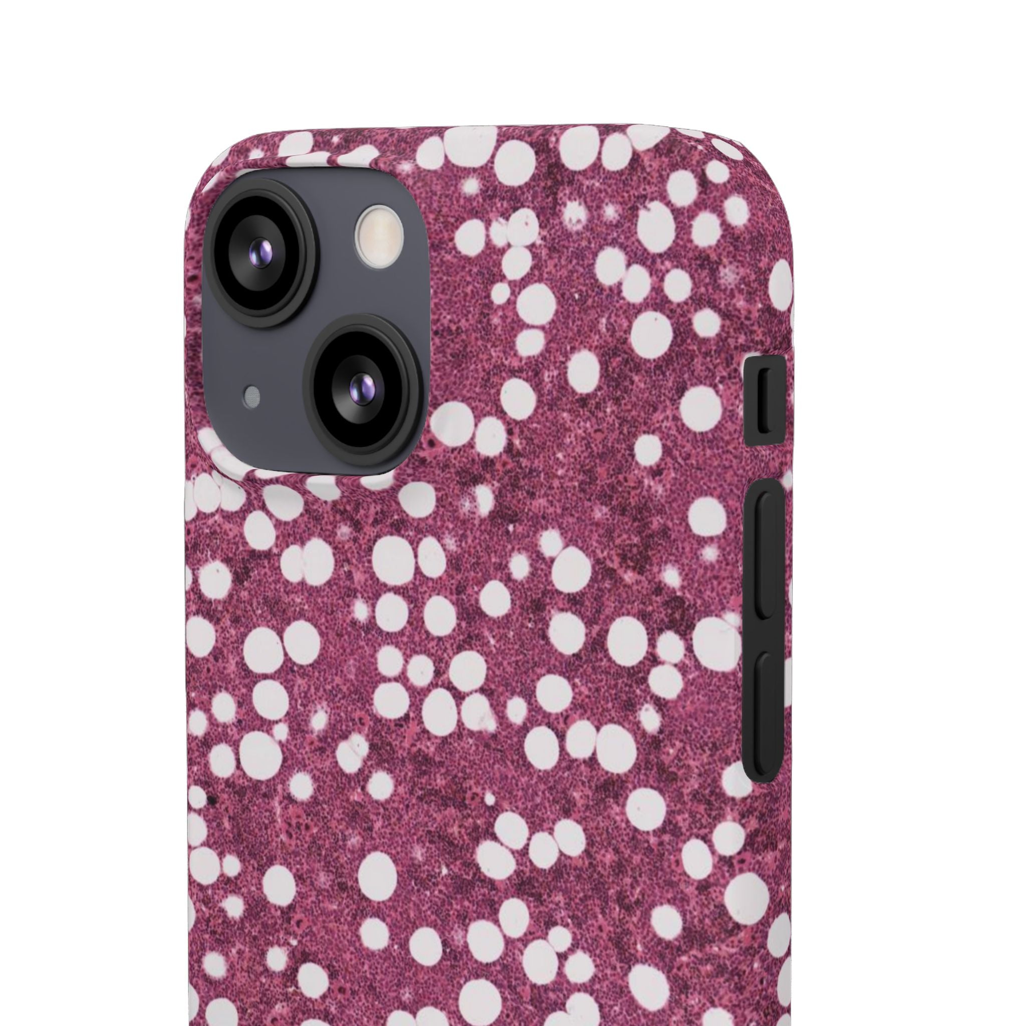 Slim Case Myelolipom