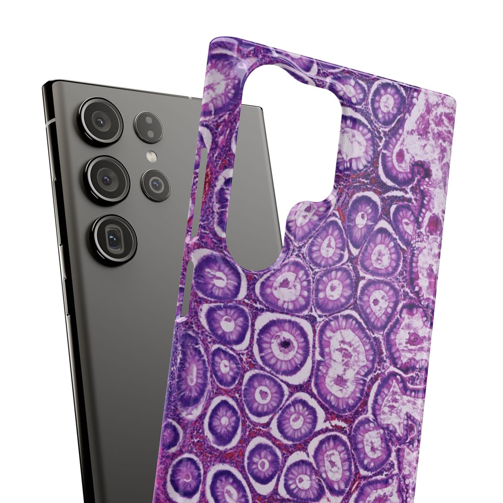 Slim Case Peutz-Jeghers Polyp