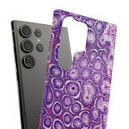 Slim Case Peutz-Jeghers Polyp