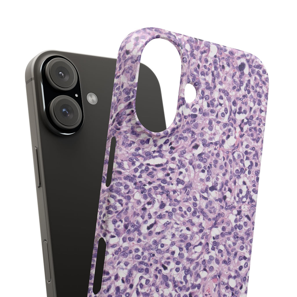Slim Case Paraganglion