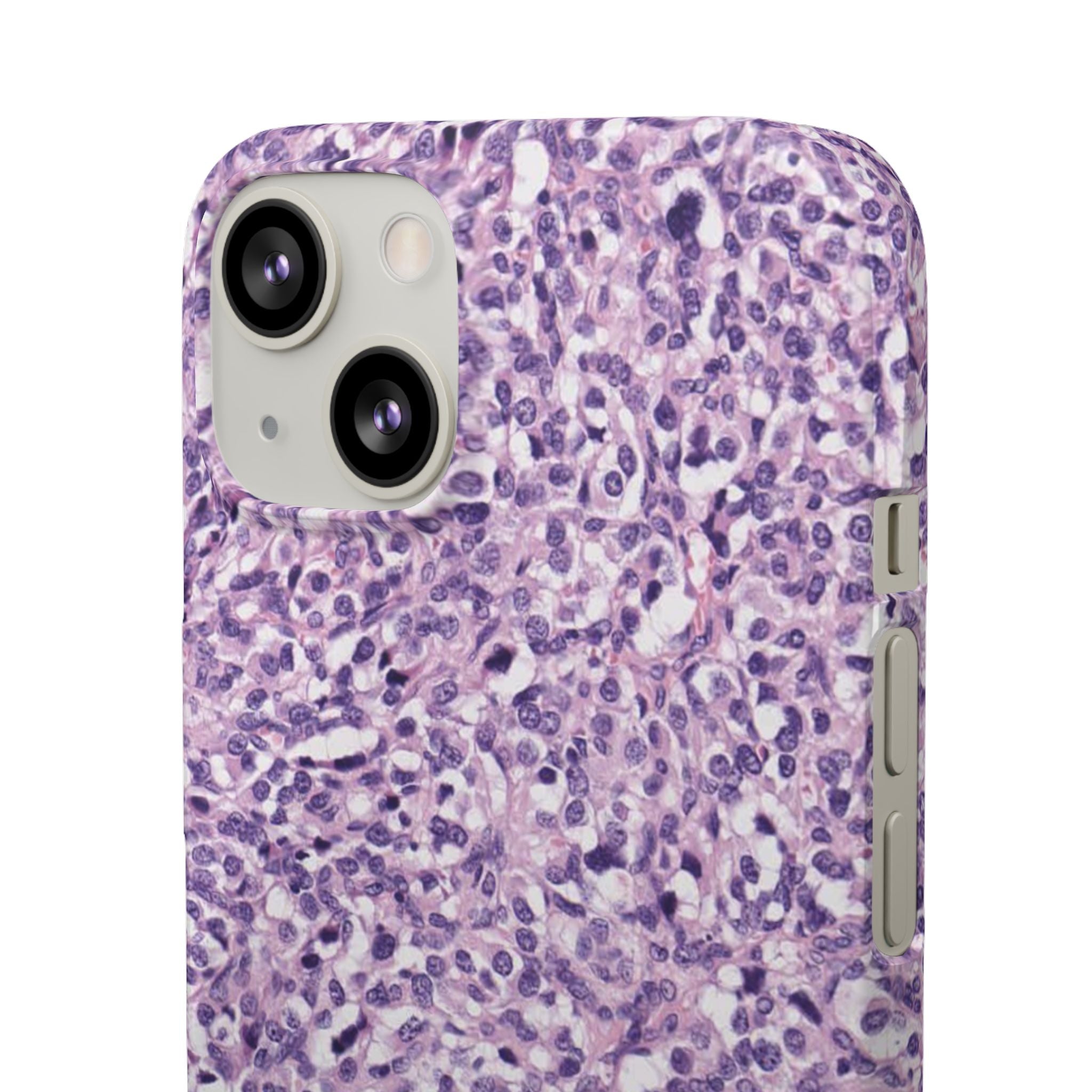 Slim Case Paraganglion