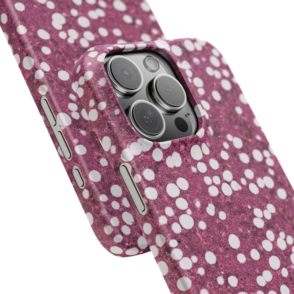 Slim Case Myelolipom