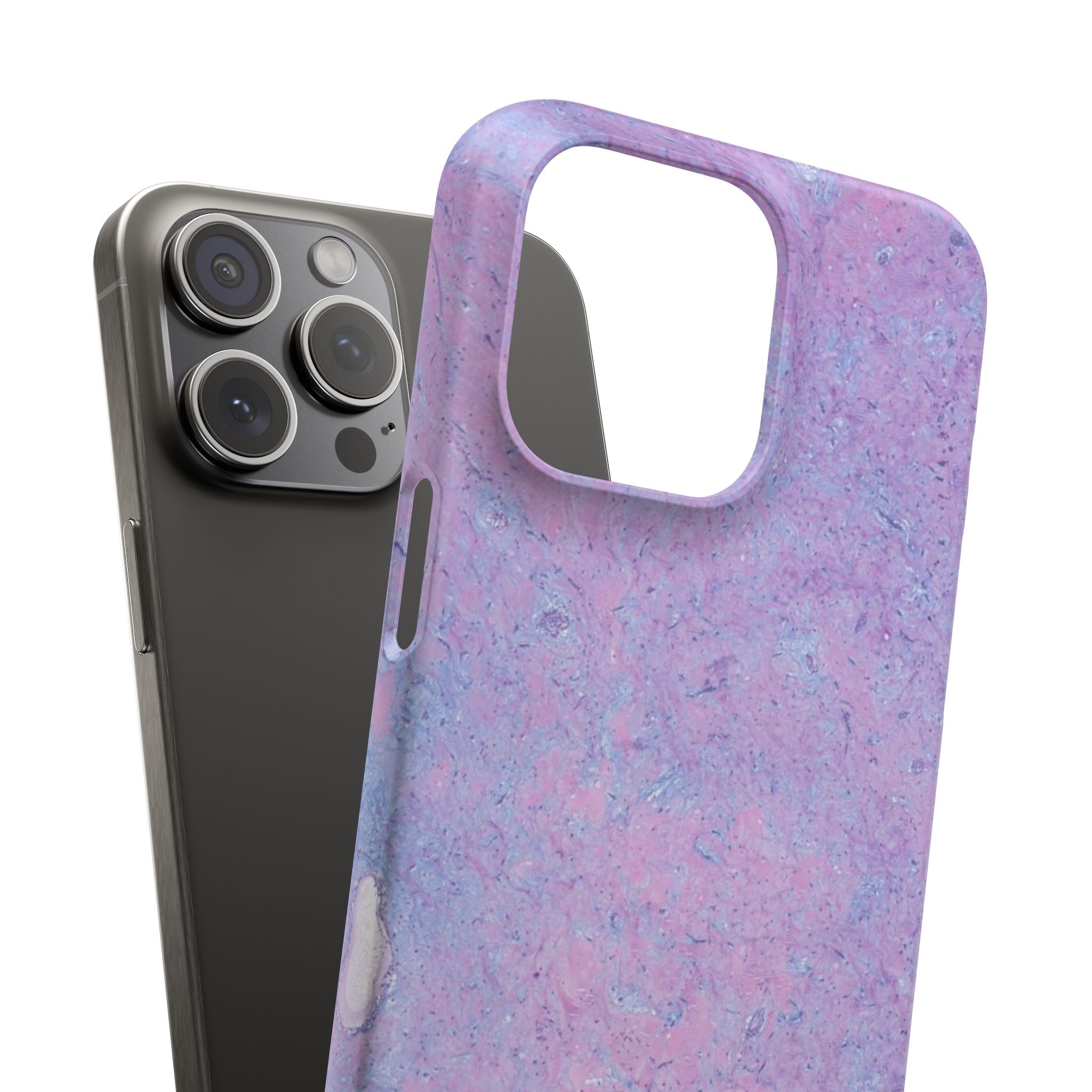 Slim Case Arterielles Myxom