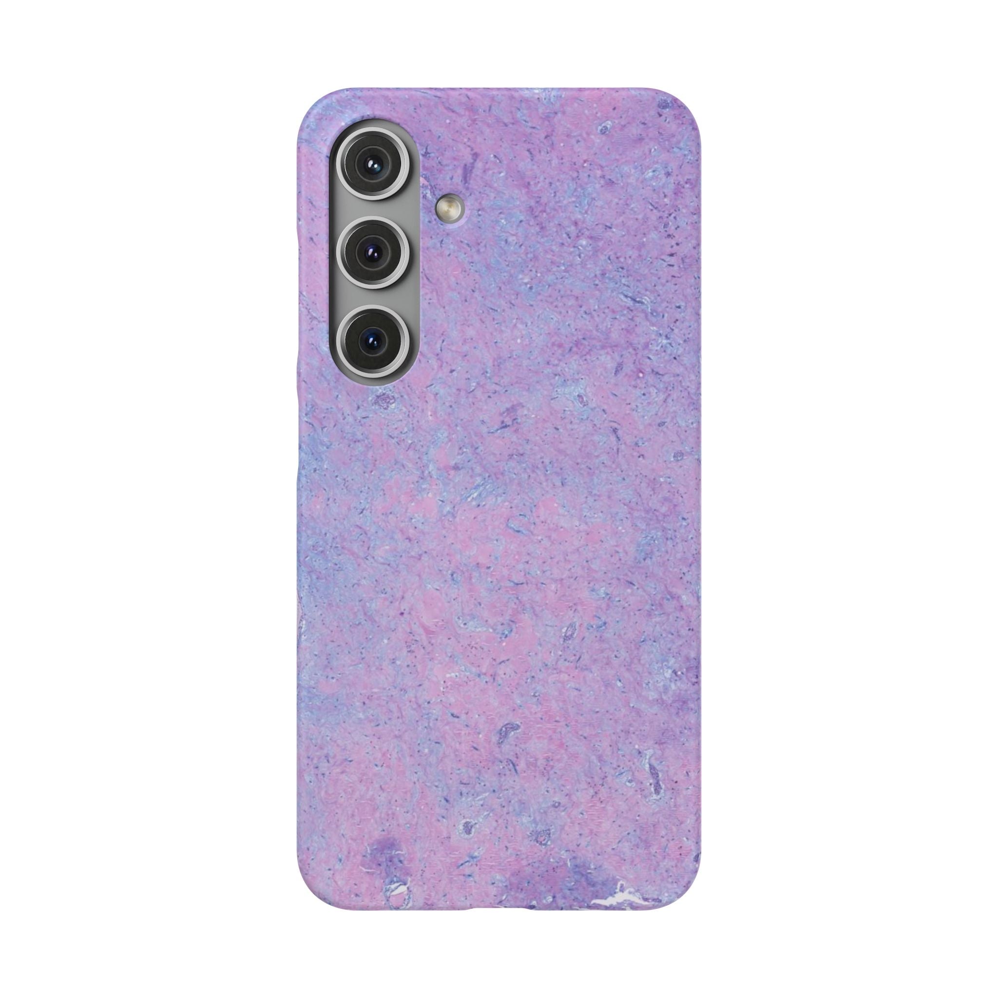 Slim Case Arterielles Myxom