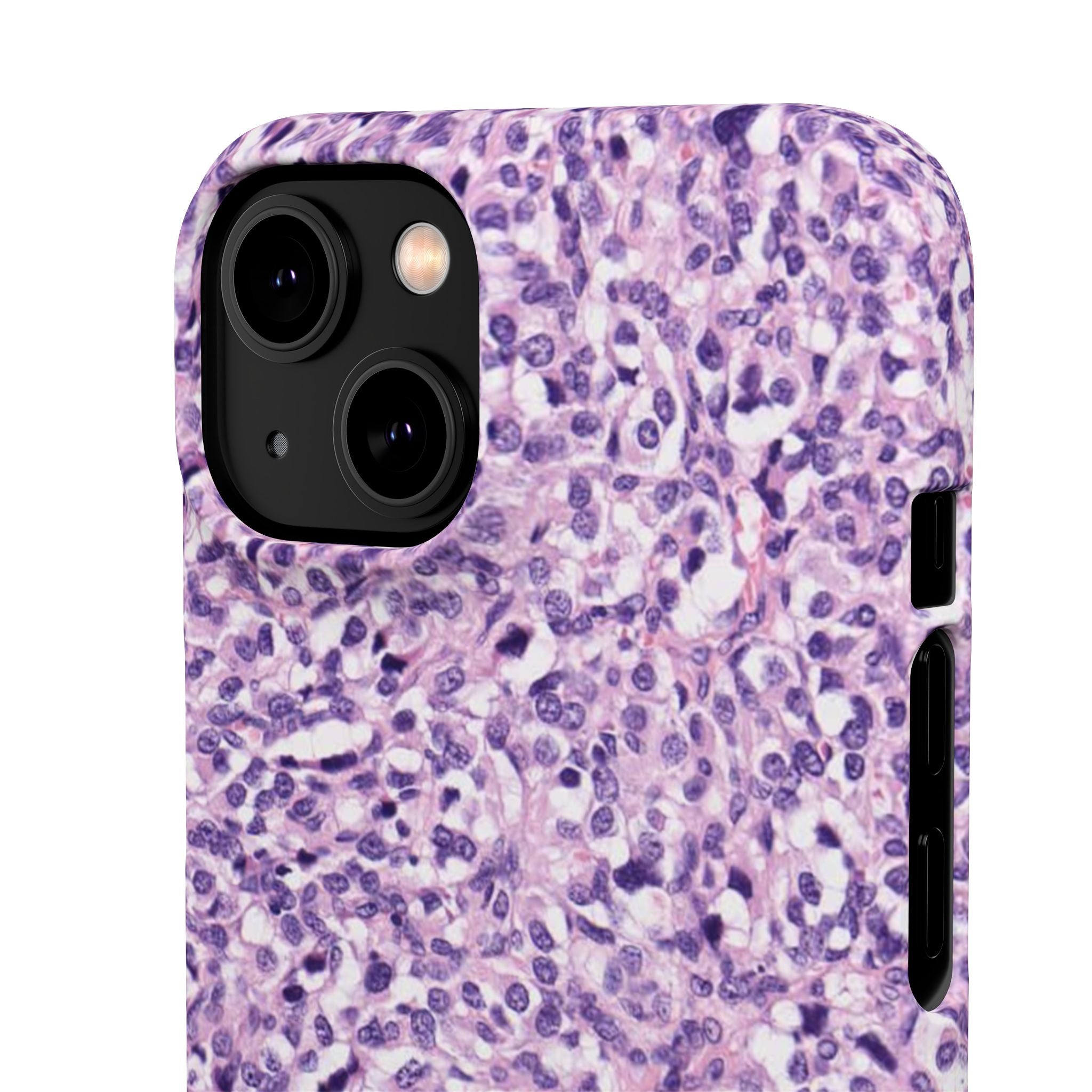 Slim Case Paraganglion