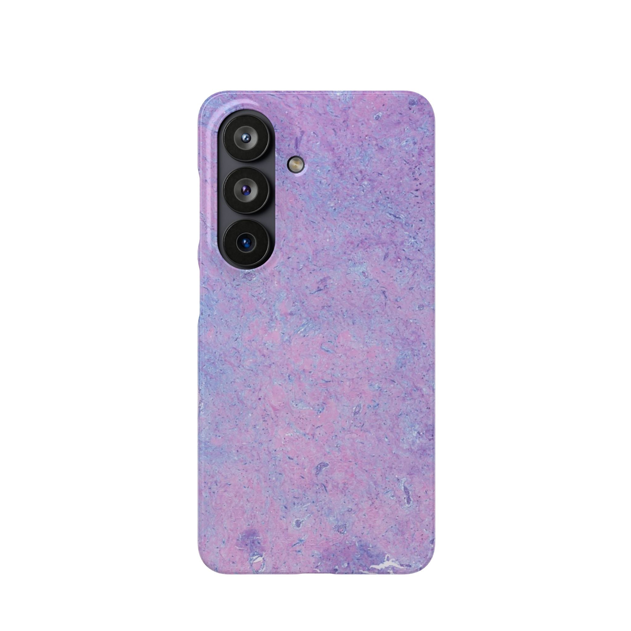 Slim Case Arterielles Myxom