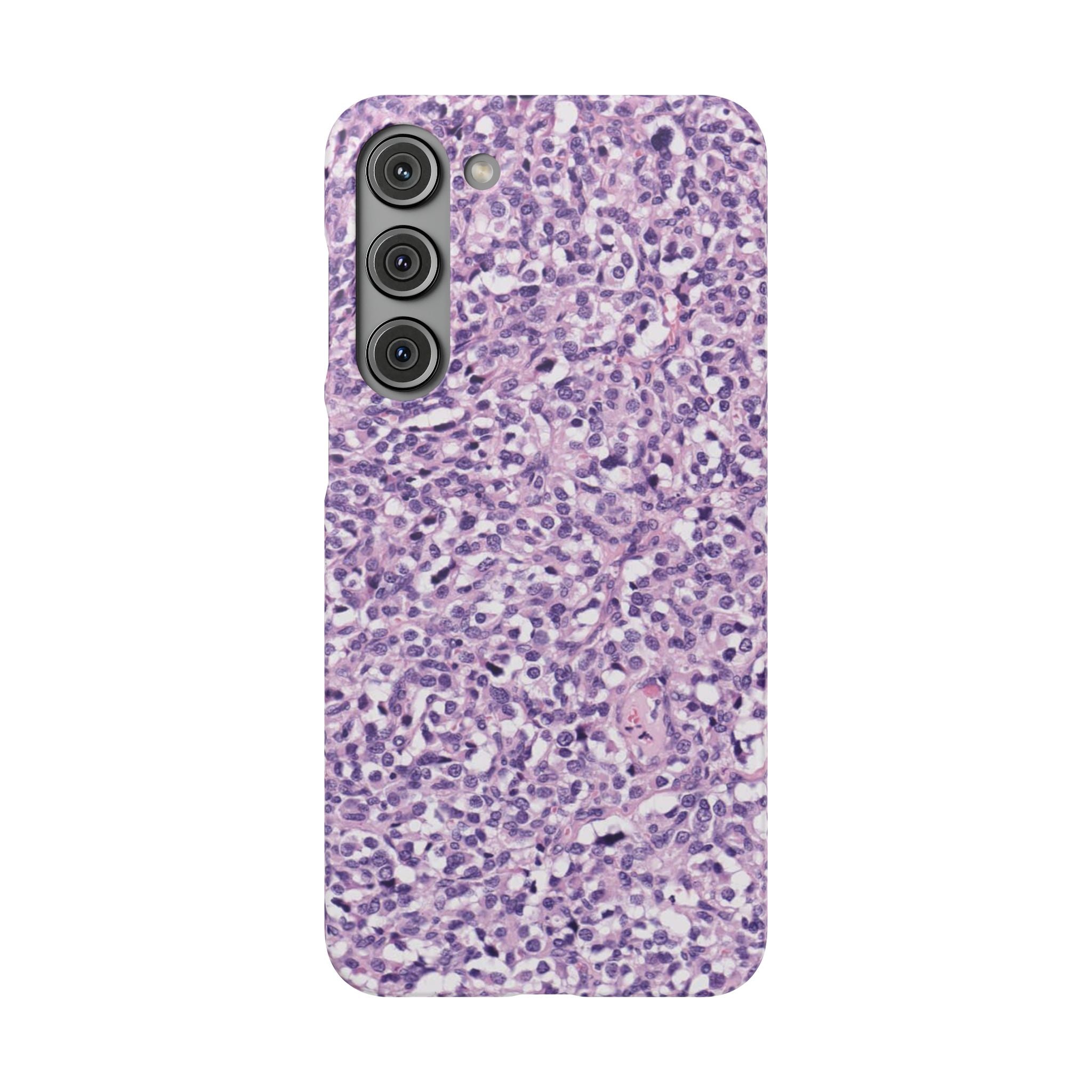 Slim Case Paraganglion