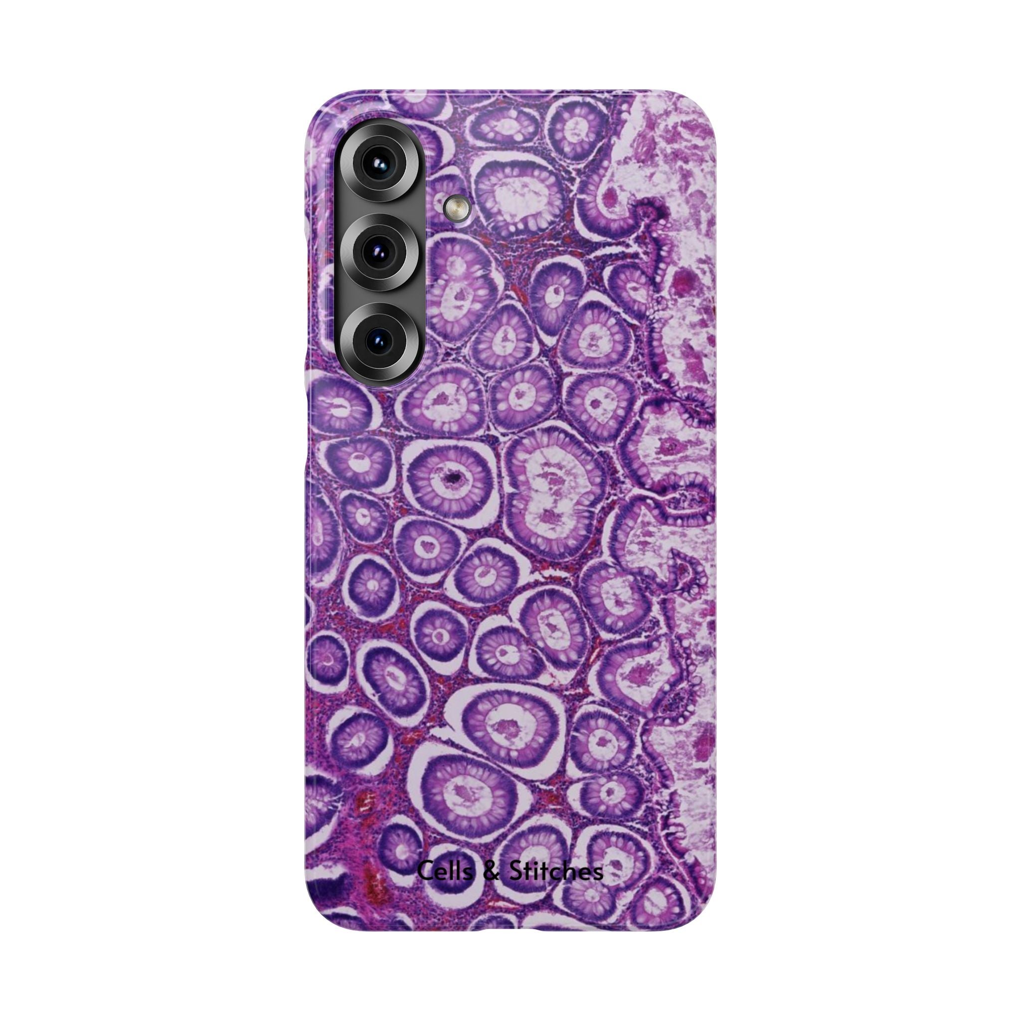 Slim Case Peutz-Jeghers Polyp