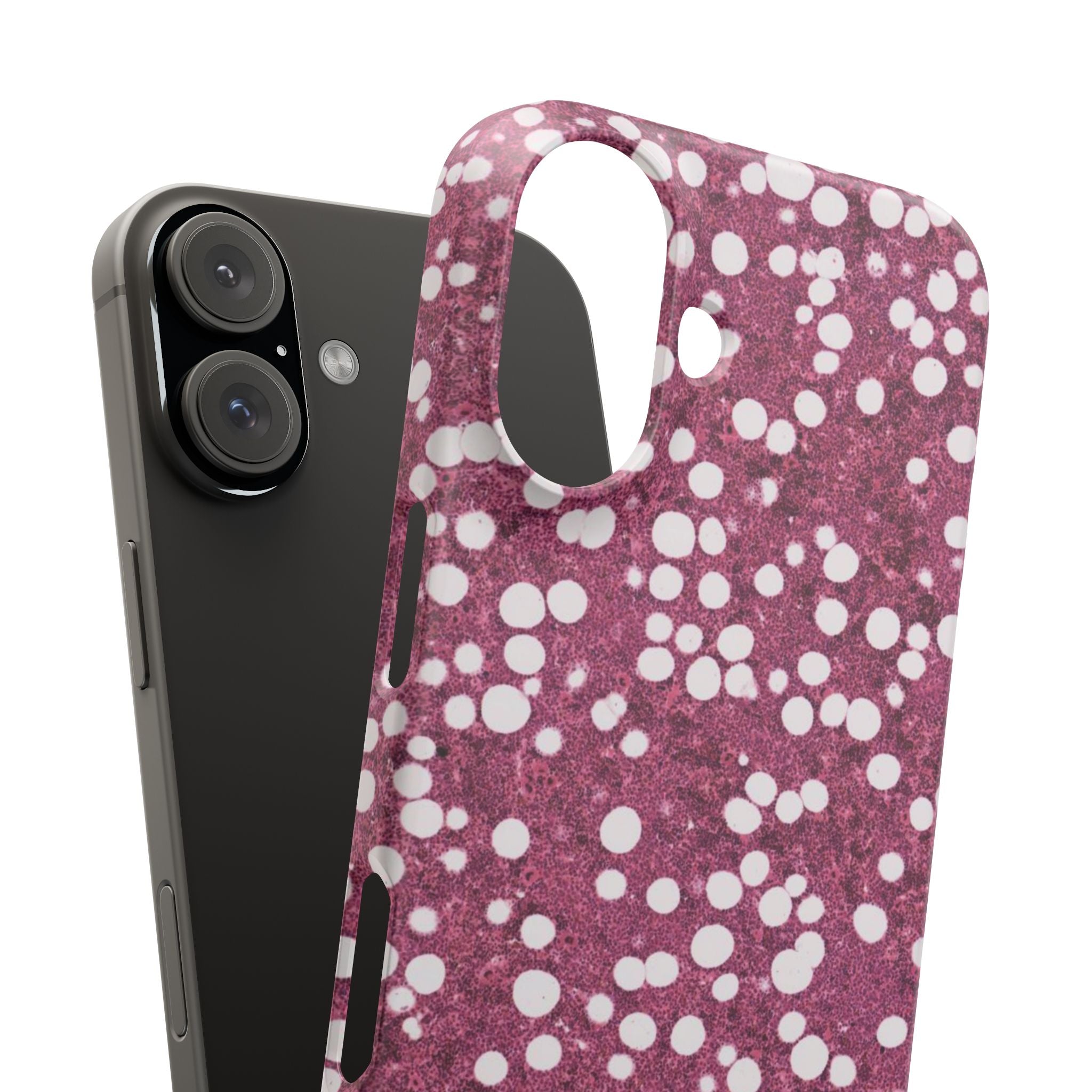 Slim Case Myelolipom