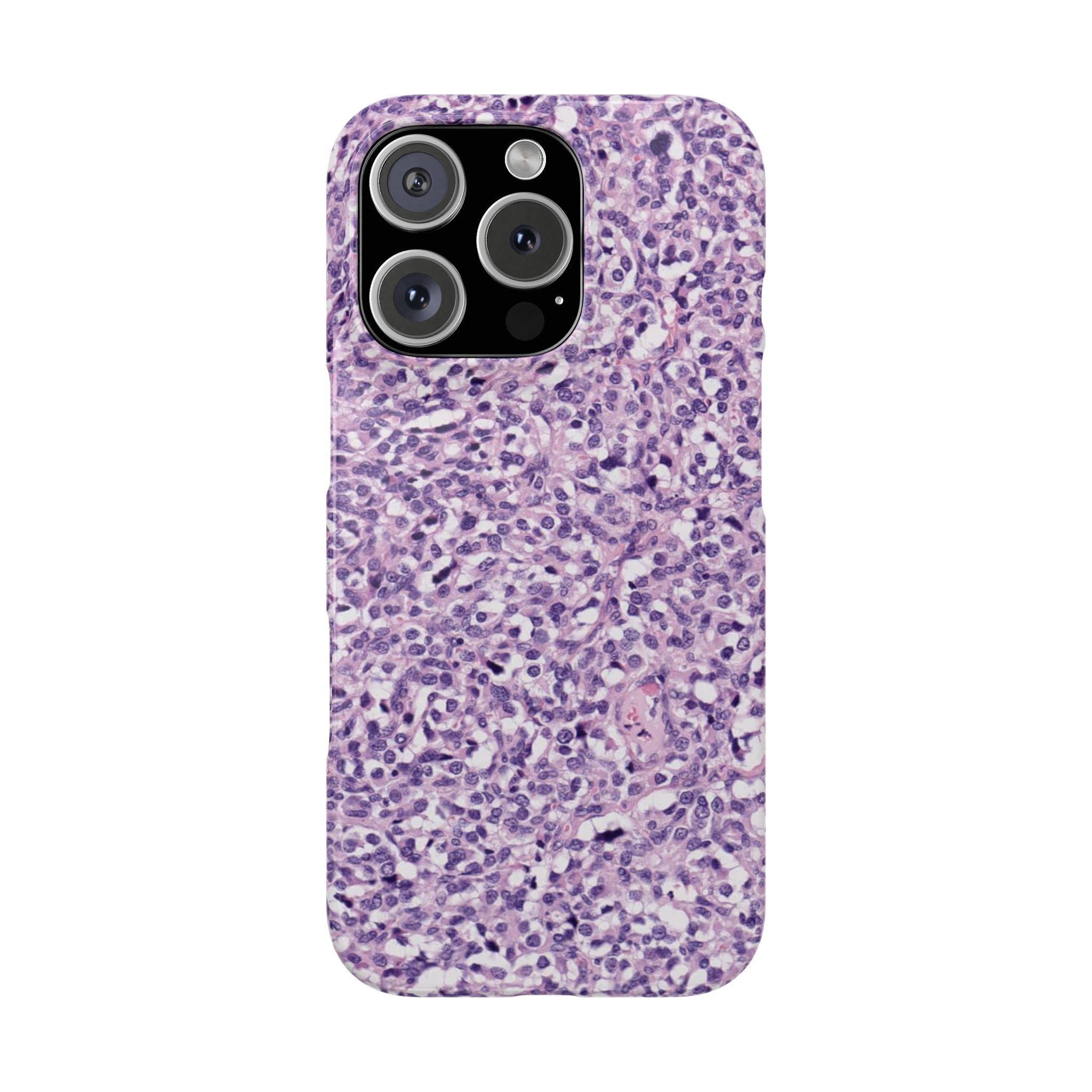 Slim Case Paraganglion