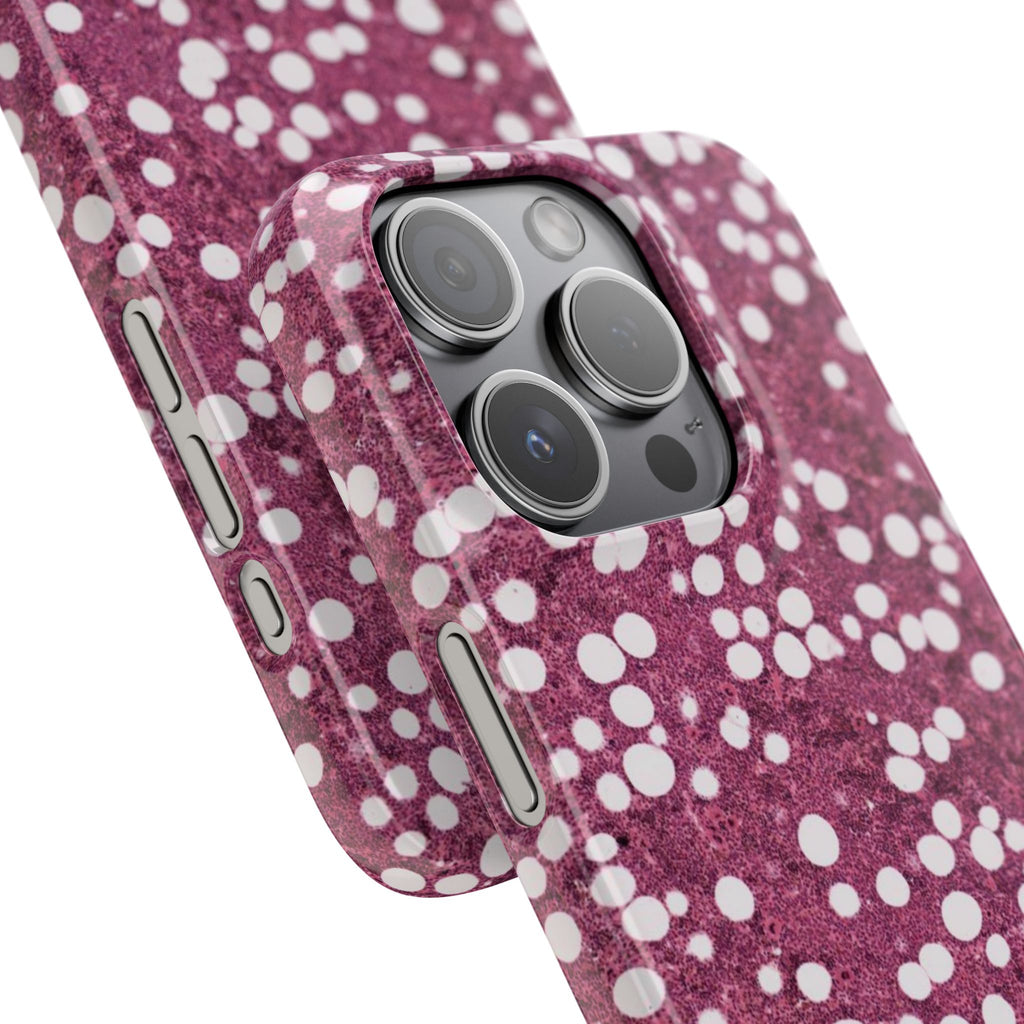 Slim Case Myelolipom