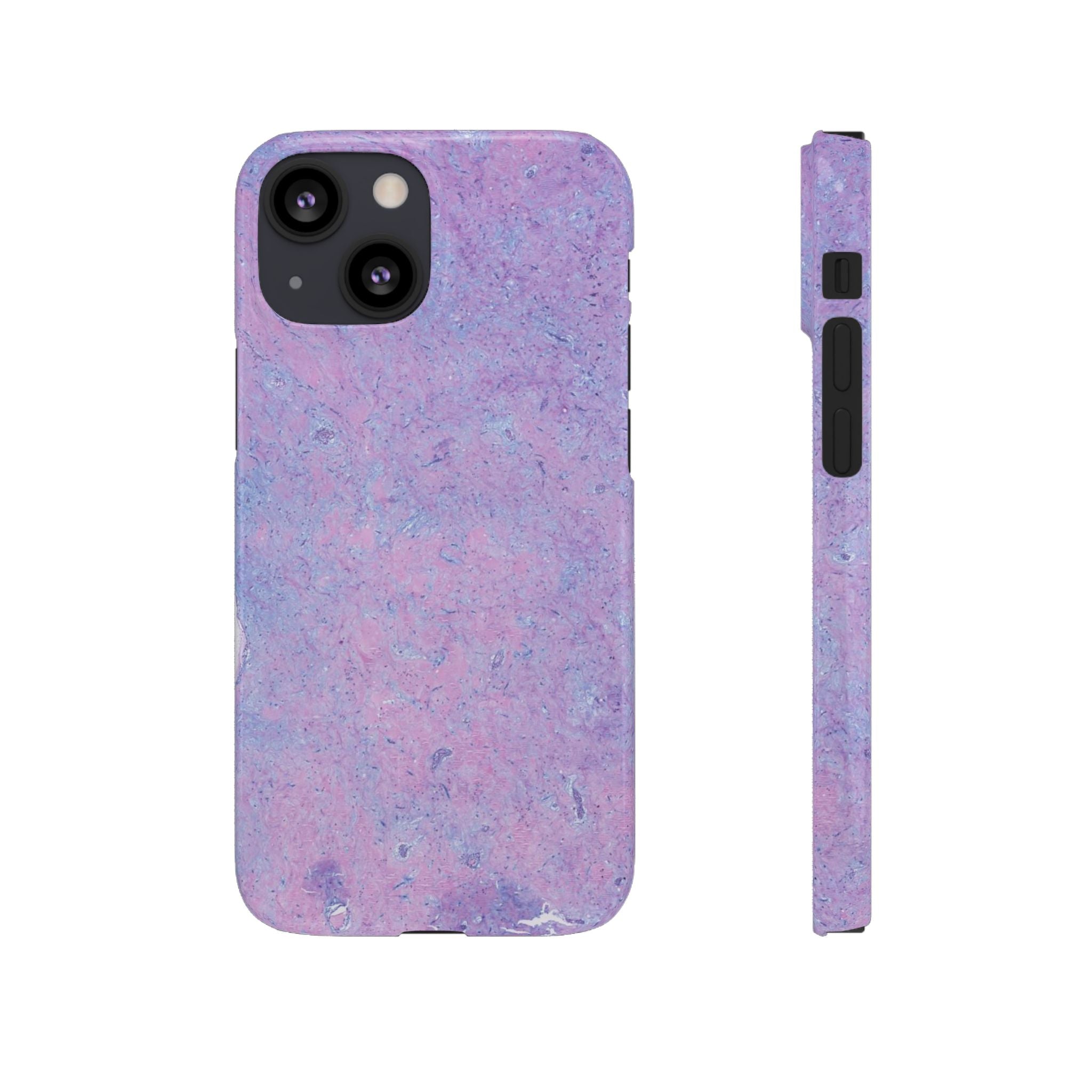 Slim Case Arterielles Myxom