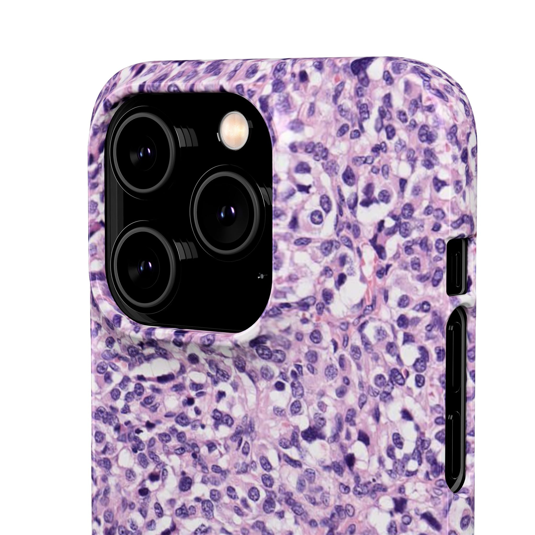 Slim Case Paraganglion