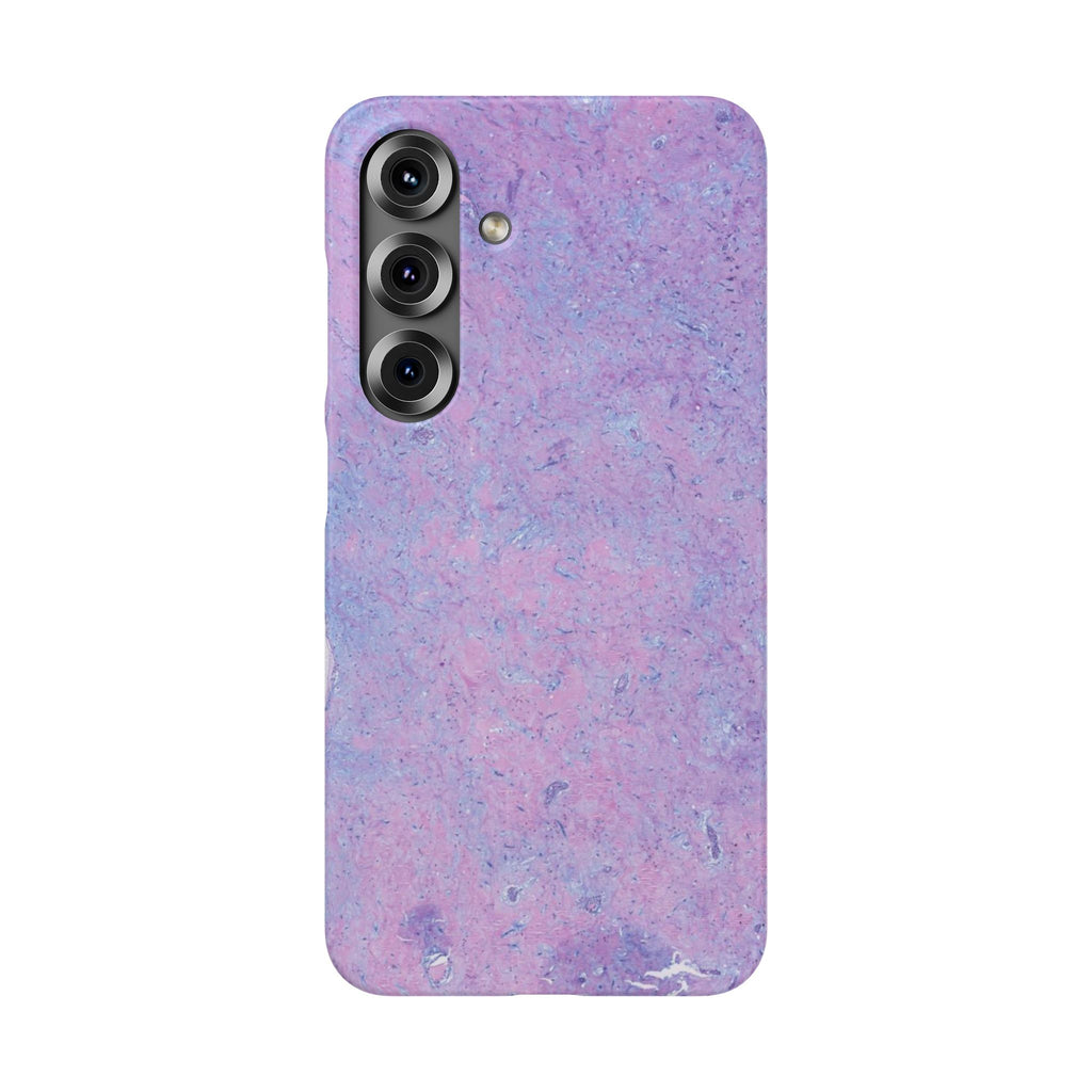 Slim Case Arterielles Myxom