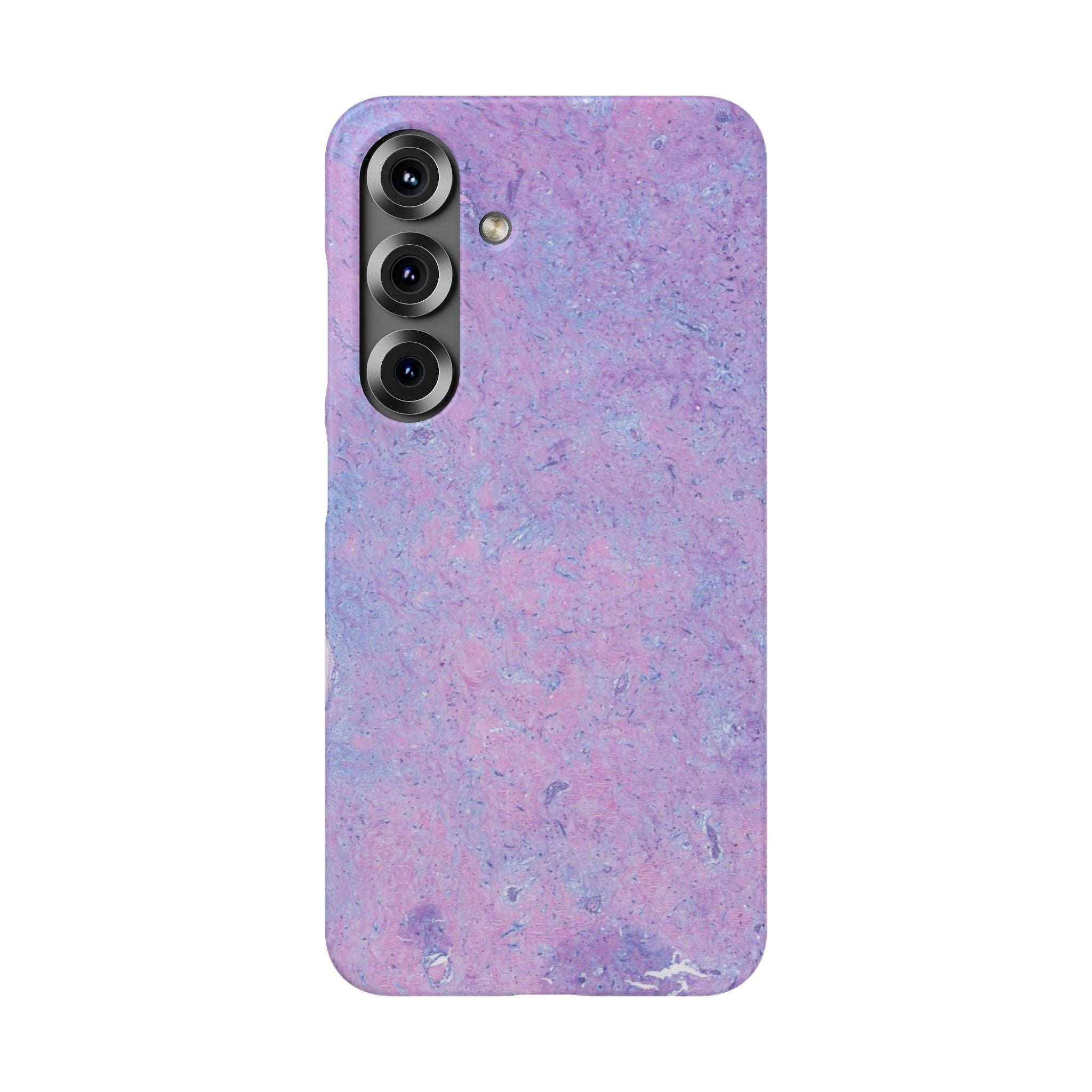 Slim Case Arterielles Myxom