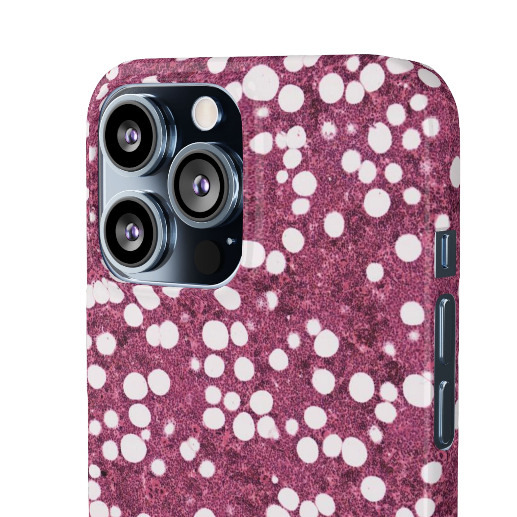 Slim Case Myelolipom