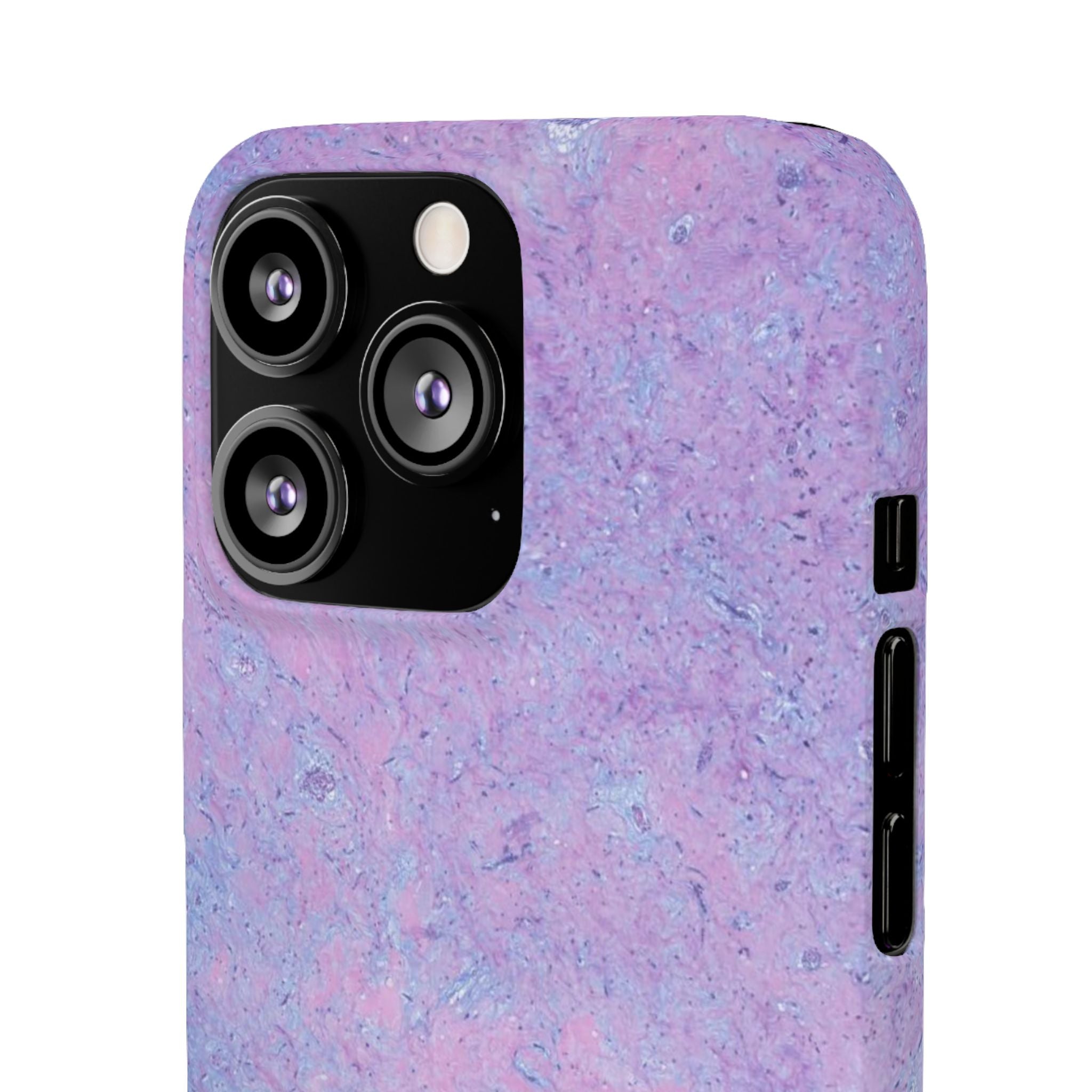 Slim Case Arterielles Myxom