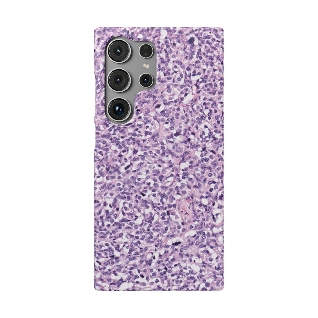 Slim Case Paraganglion