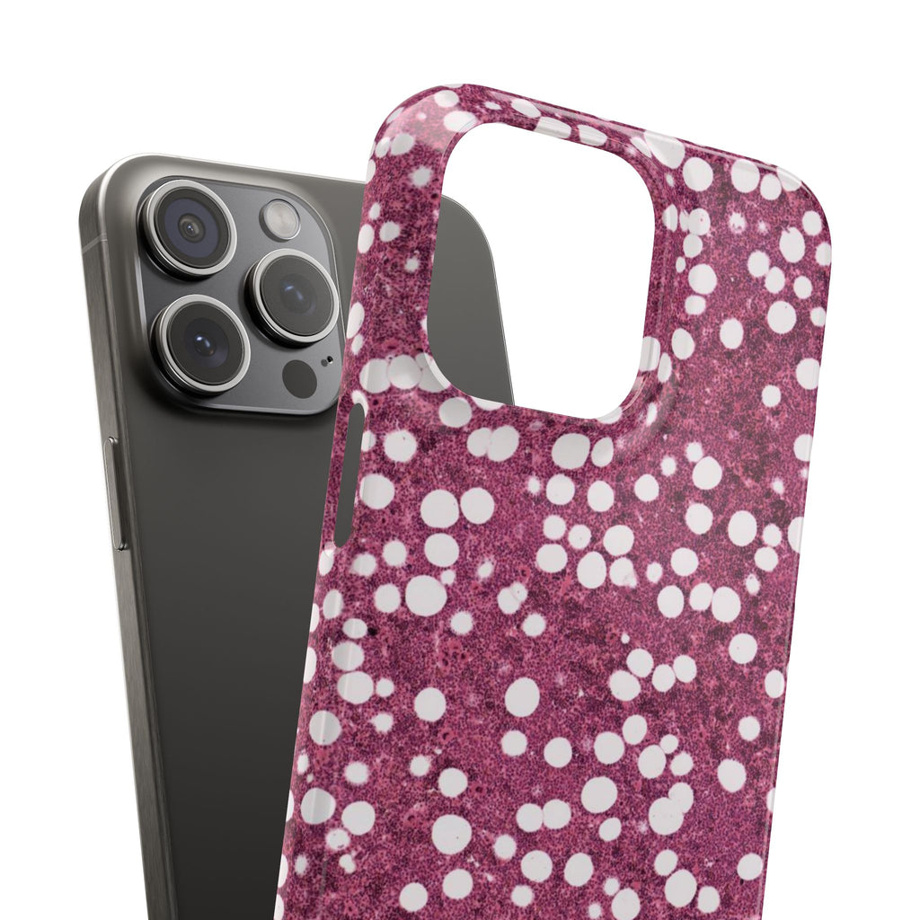 Slim Case Myelolipom