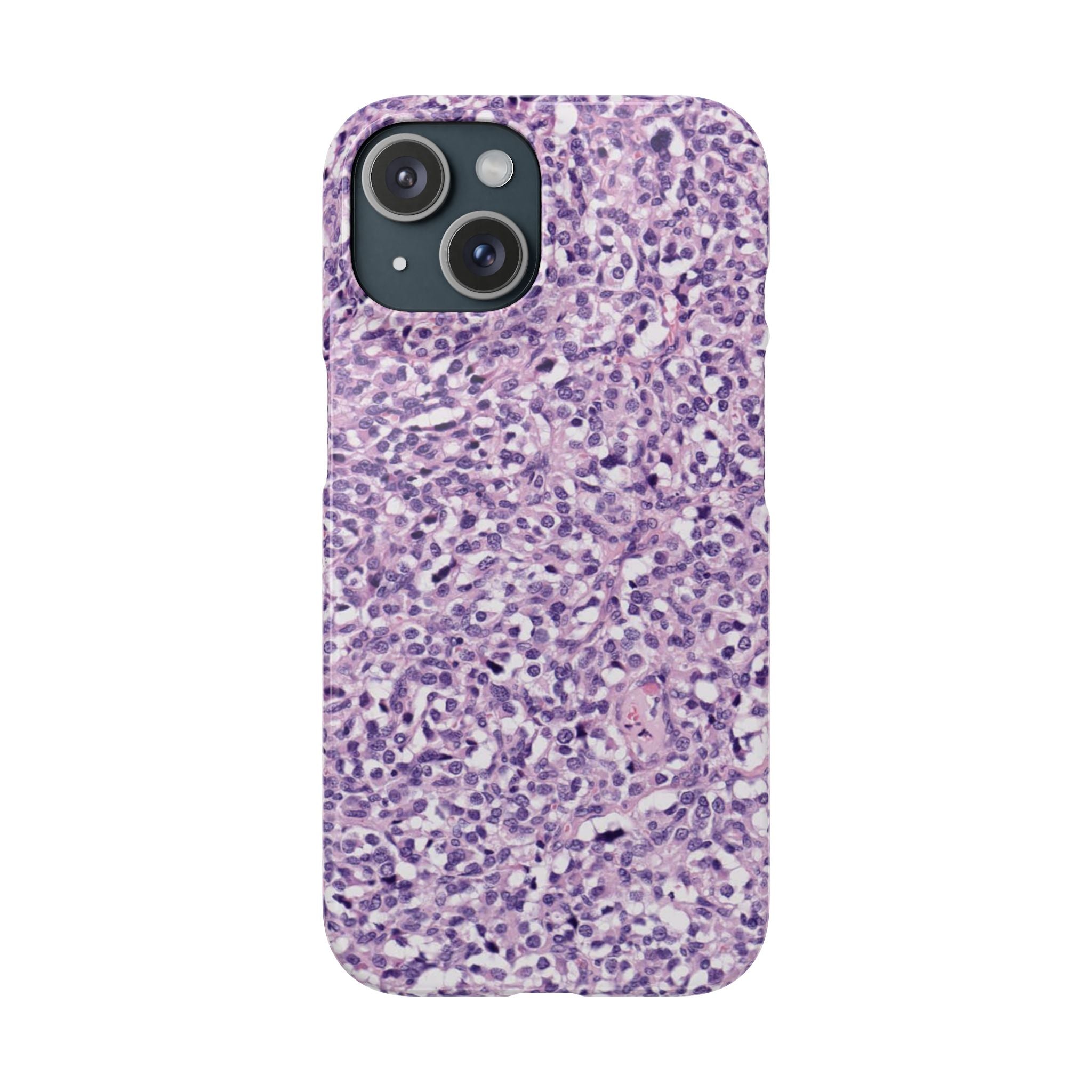 Slim Case Paraganglion