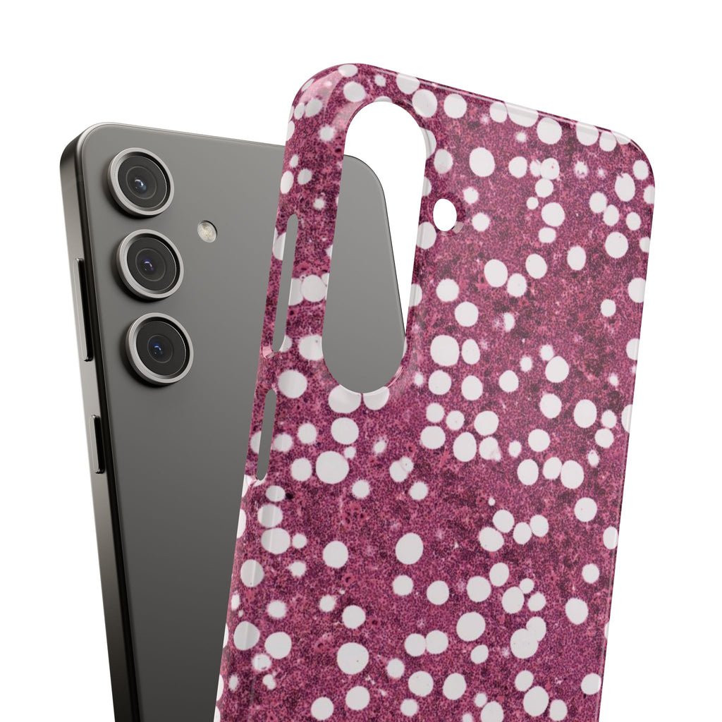 Slim Case Myelolipom