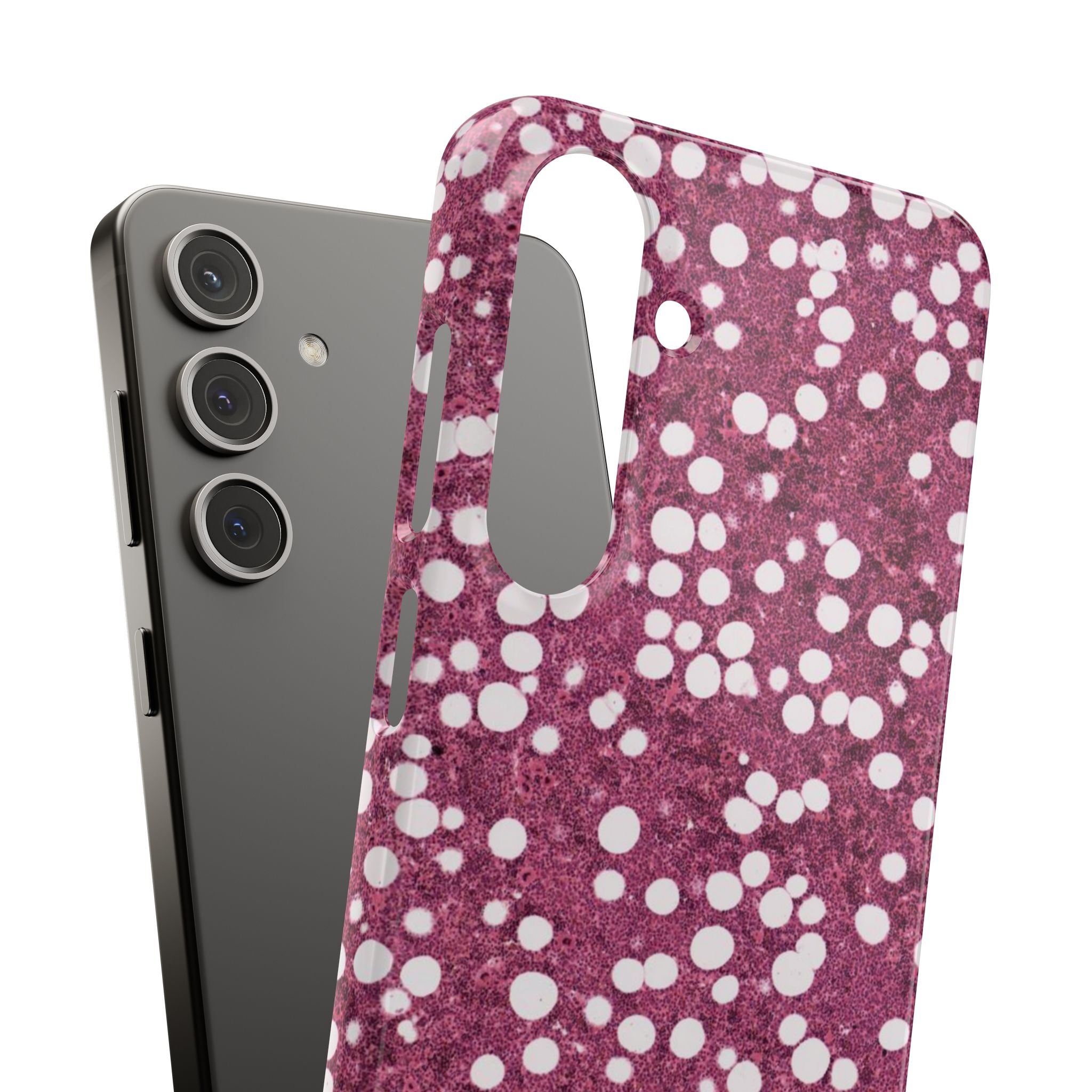 Slim Case Myelolipom