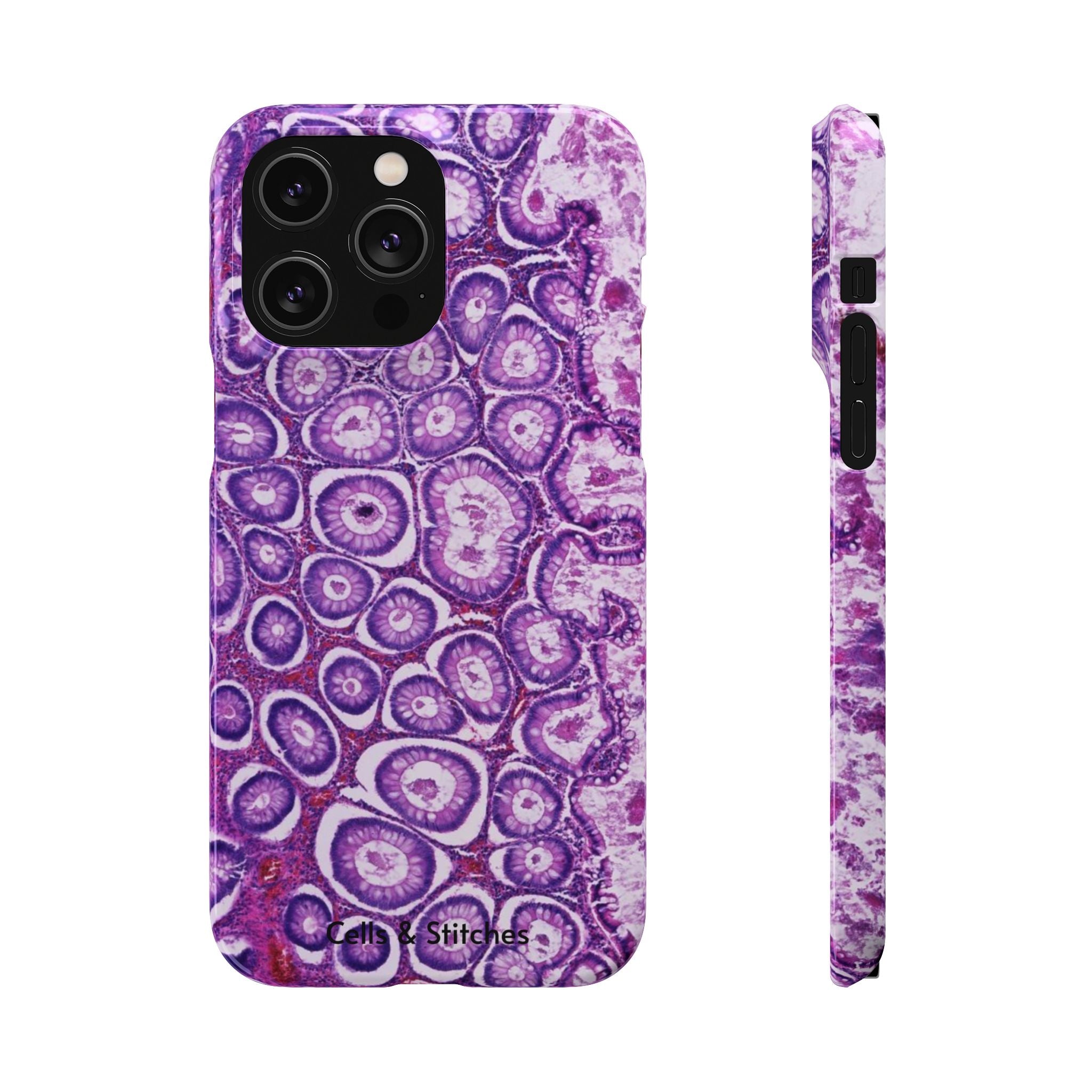 Slim Case Peutz-Jeghers Polyp