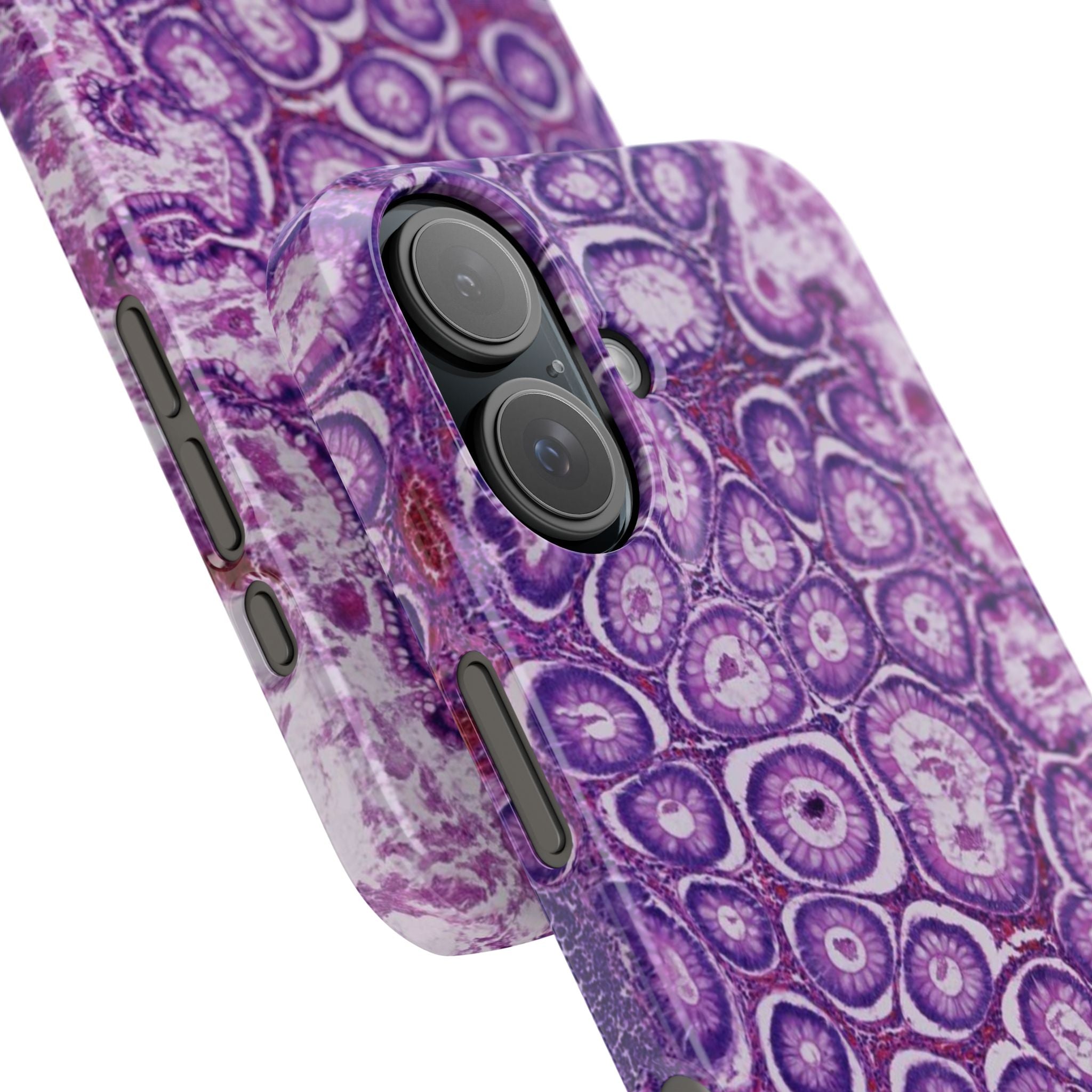 Slim Case Peutz-Jeghers Polyp