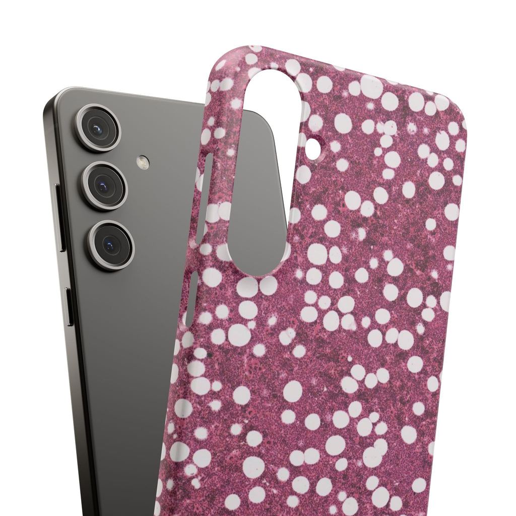 Slim Case Myelolipom