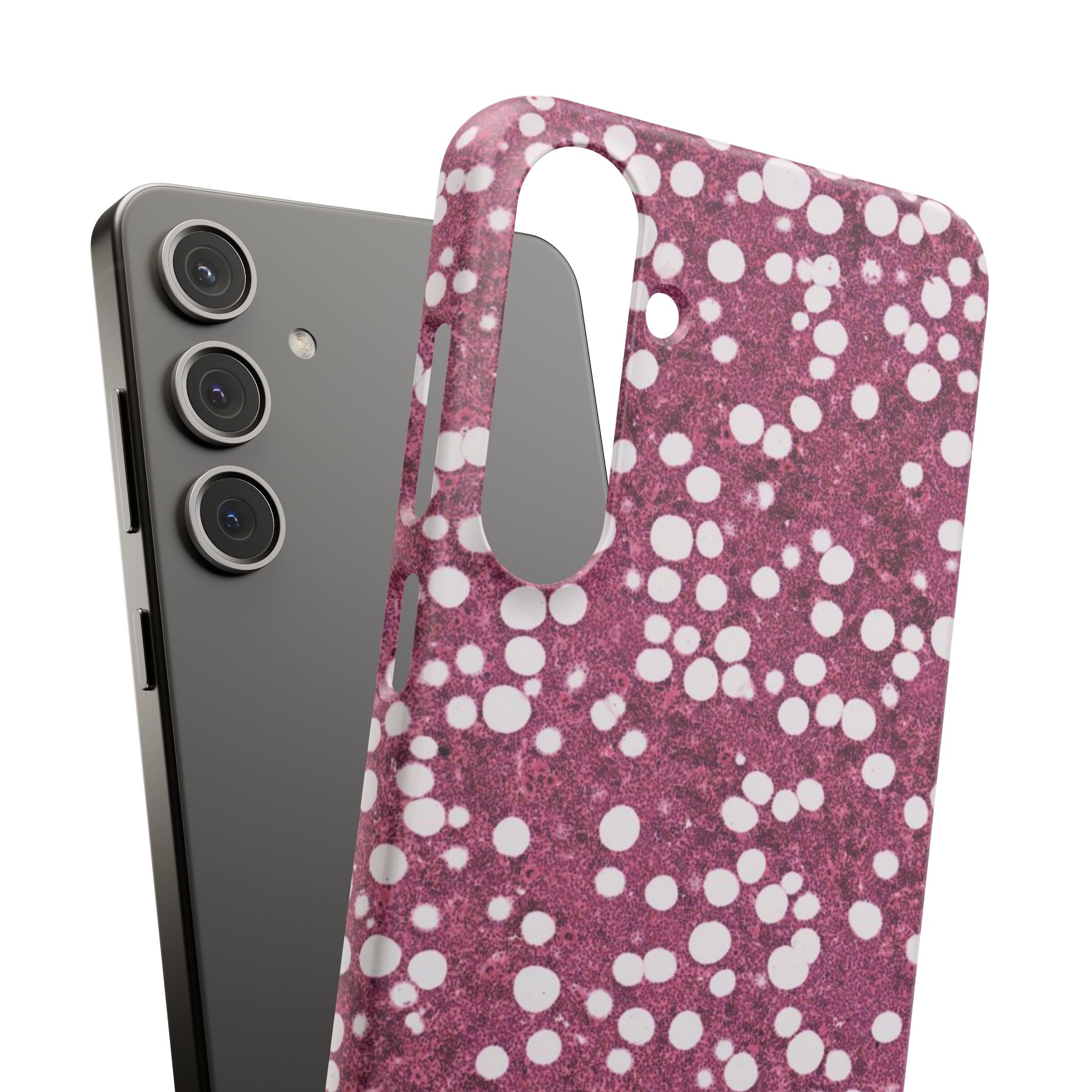 Slim Case Myelolipom
