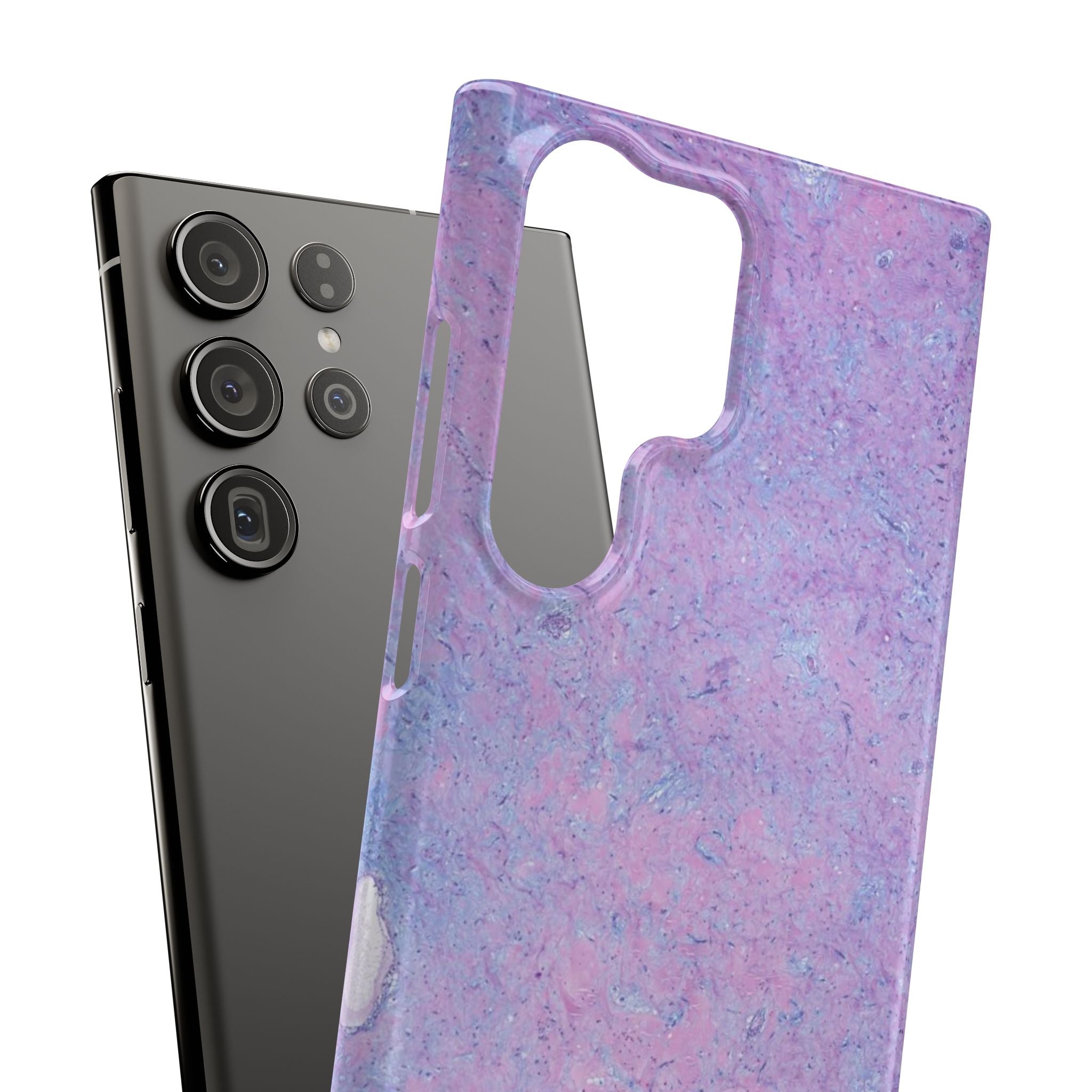 Slim Case Arterielles Myxom