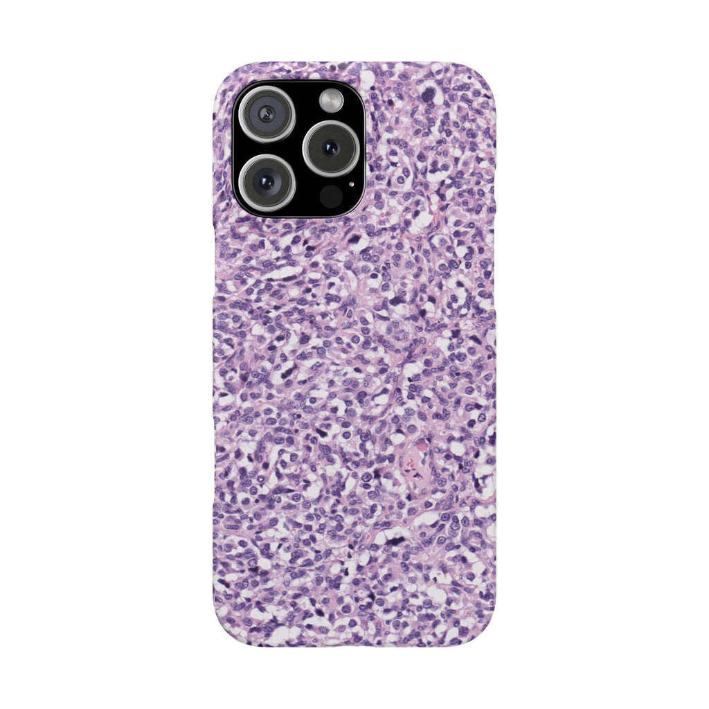 Slim Case Paraganglion