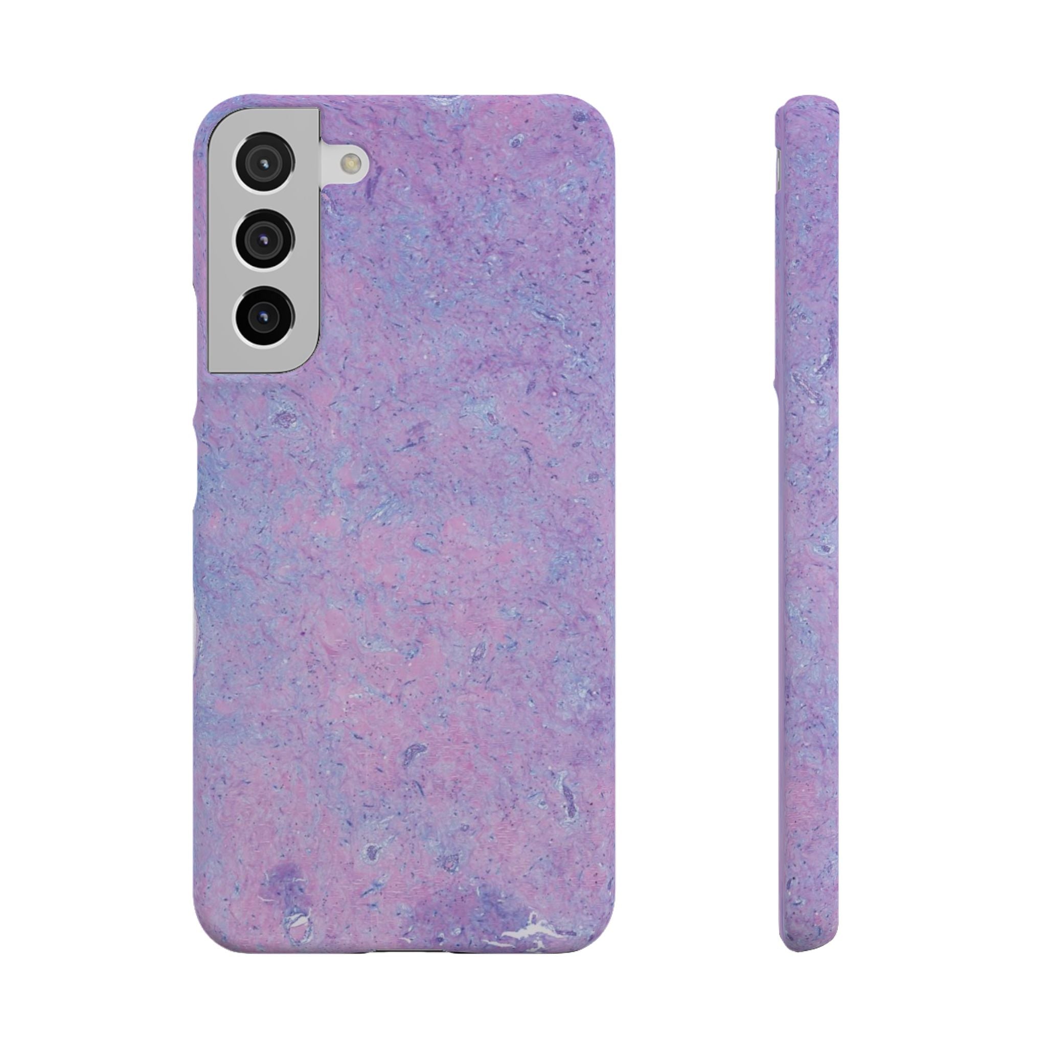 Slim Case Arterielles Myxom