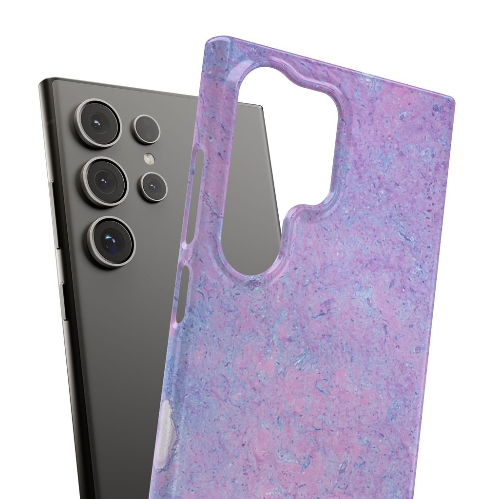 Slim Case Arterielles Myxom