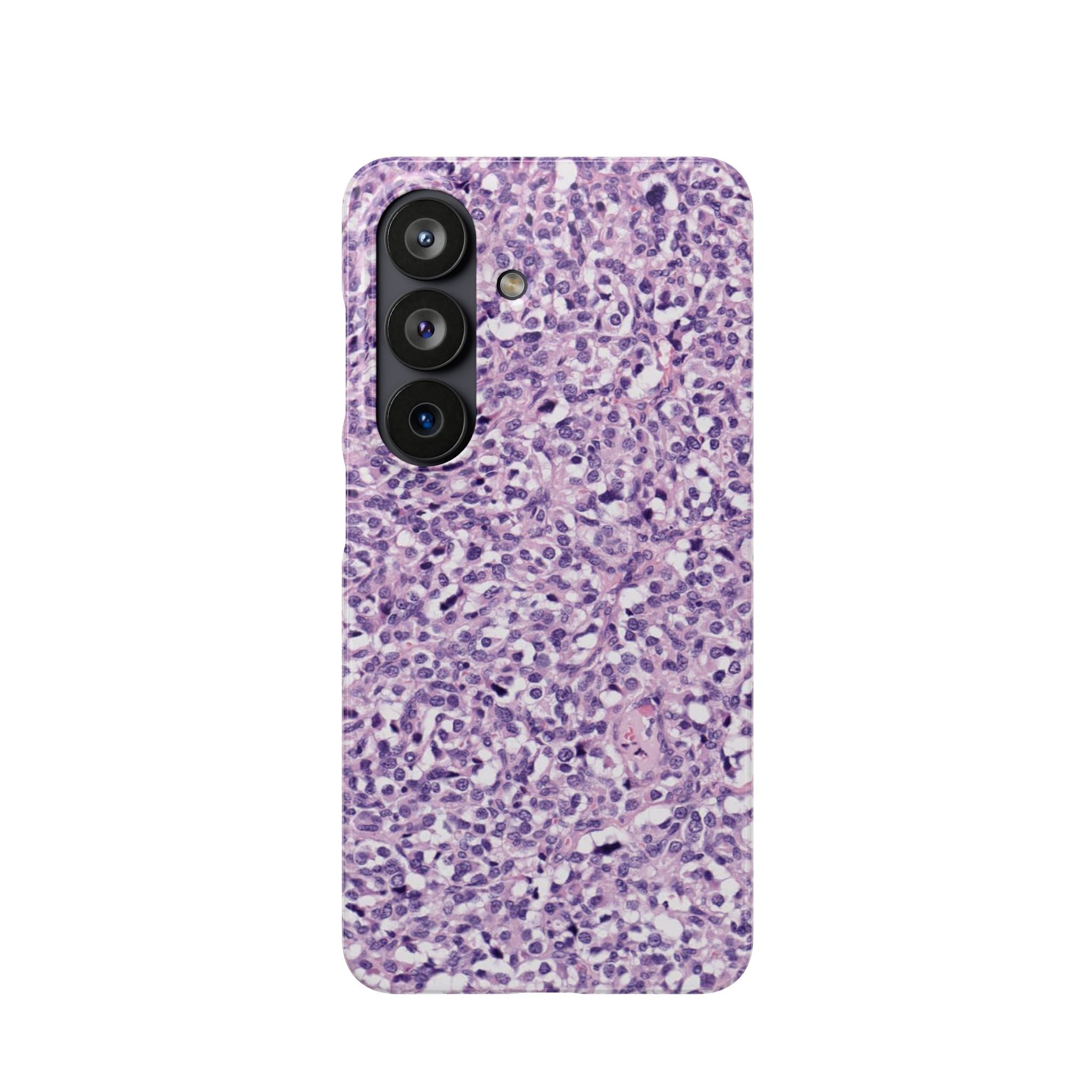 Slim Case Paraganglion