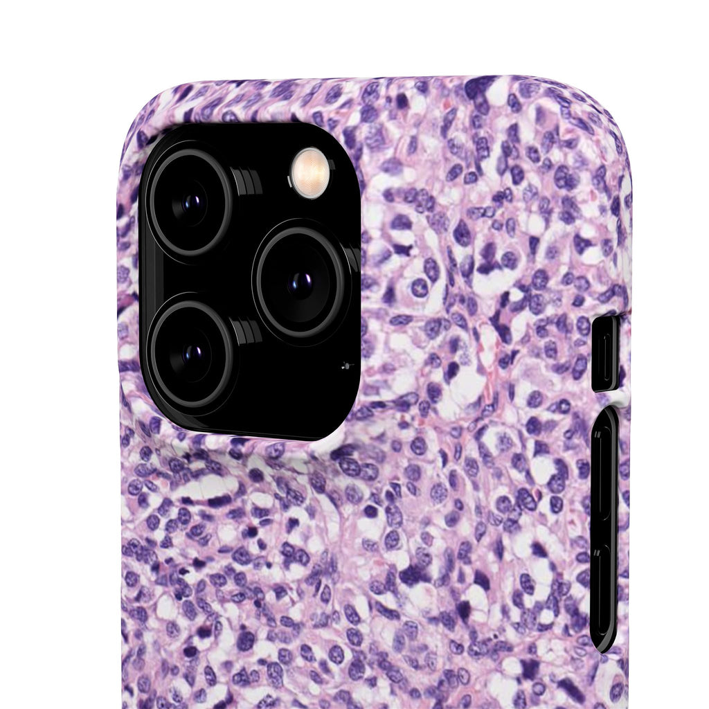 Slim Case Paraganglion